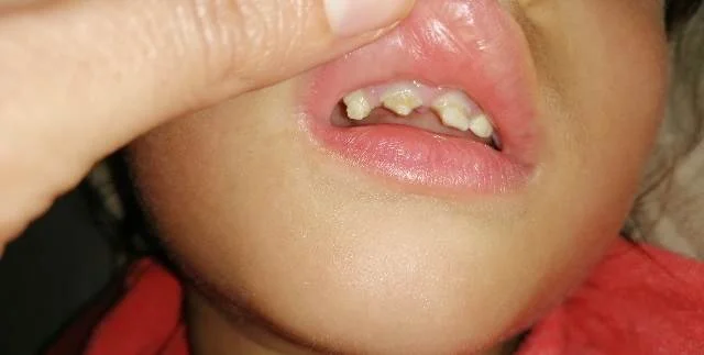Close-up of a child's mouth showing multiple decayed and missing teeth.