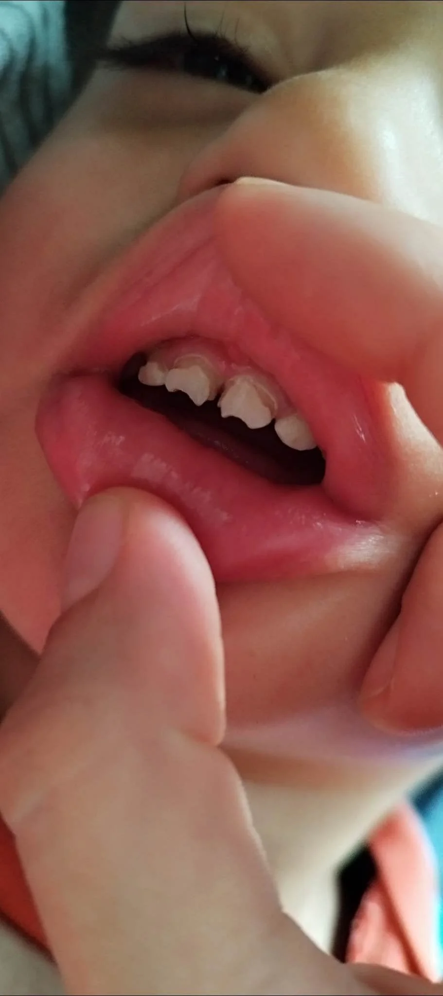 Close-up of a person's mouth with baby teeth visible inside, fingers holding open the lips, and a part of the person's face visible in the background.