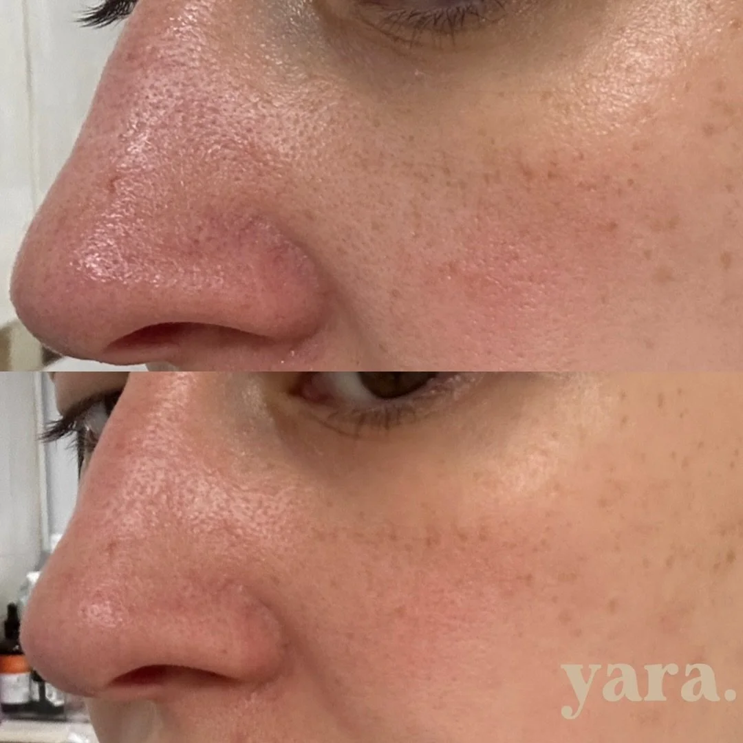 One BioRePeel later! I thought I&rsquo;d share my own results after the peel and before introducing it to you all 🤍 ⁣
⁣
Smaller pores ✔️⁣
CLEANER pores ✔️⁣
Smoother skin ✔️⁣
⁣
I will keep you all updated on my progress as I am now addicted ⁣
⁣
BioRe