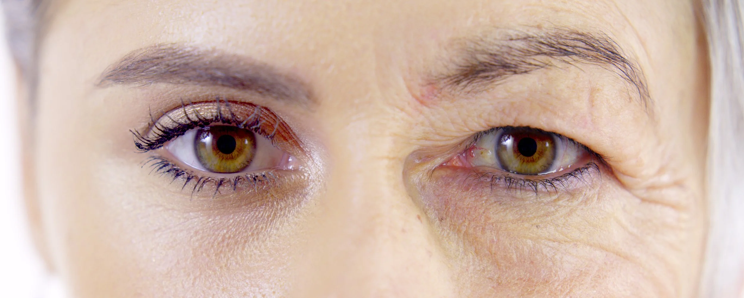 Close-up of a woman's eyes showing a pre and post blepharoplasty appearance.