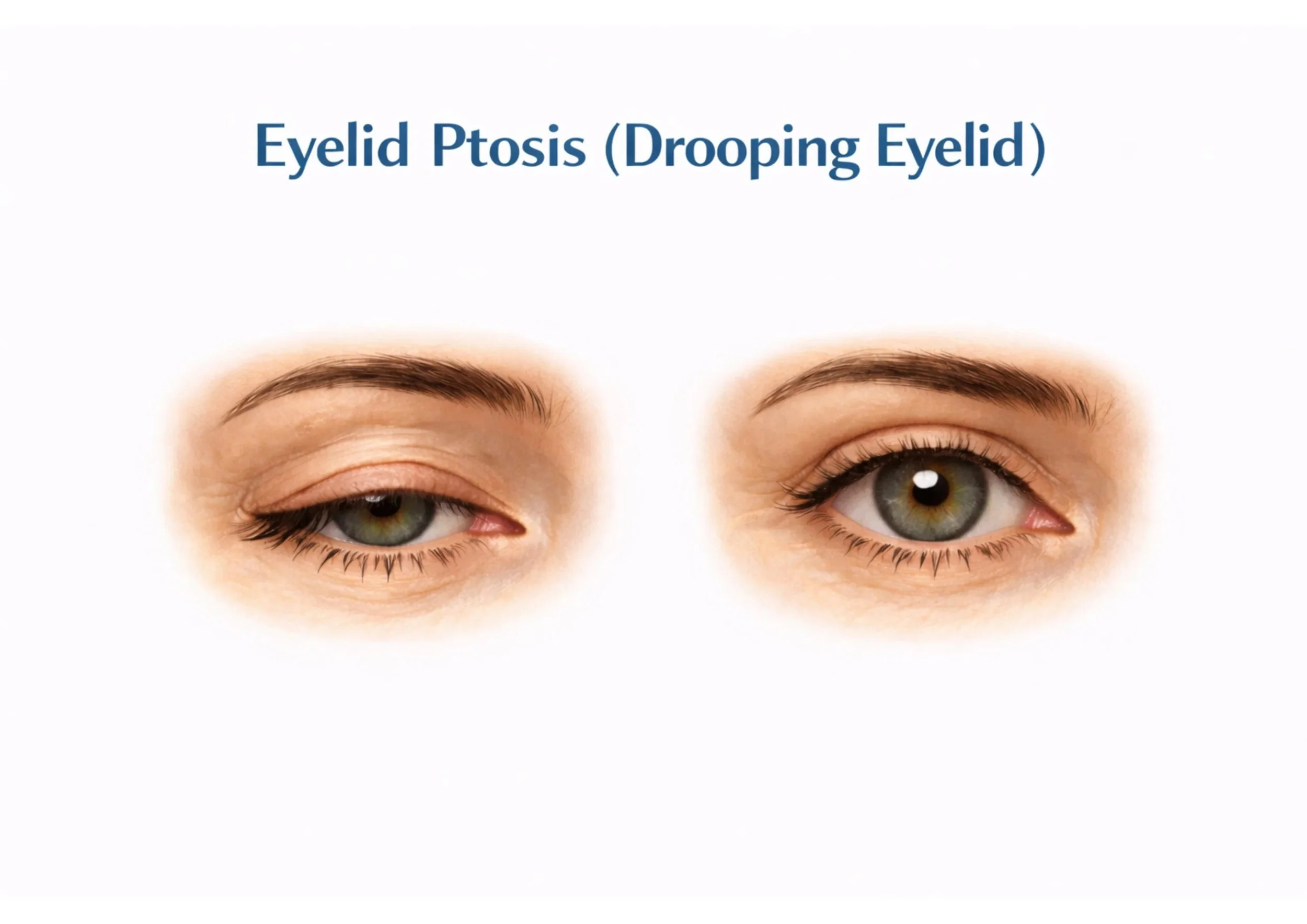 Comparison of two eyes demonstrating eyelid ptosis, with the left eye drooping and the right eye normal.