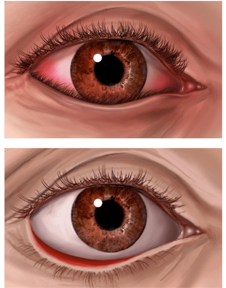 Digital illustration of a human eye, showing a comparison between a lower eyelid entropion and a lower eyelid ectropion.