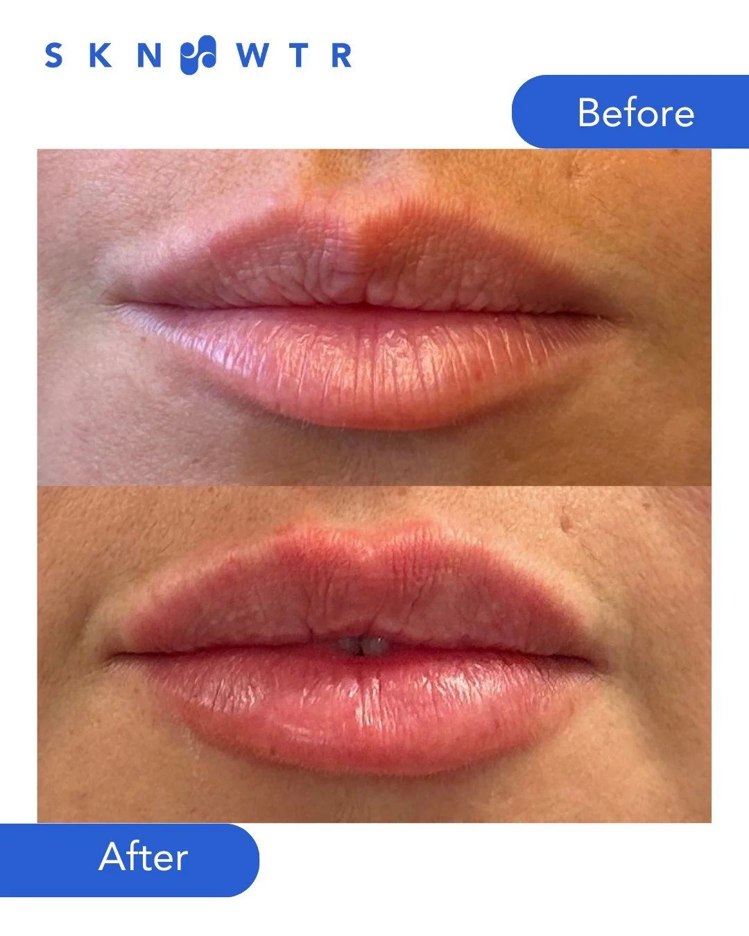 @thebostoninjector_ 

Adding a touch of volume and perfecting symmetry. The recipe for success! 

New patients get $75 off their first treatment. Book now!
