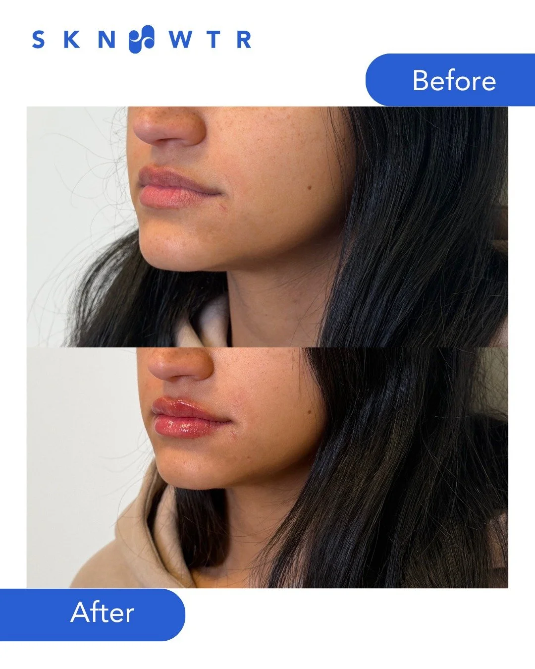 First time lips, just a little glow-up!

Subtle volume, softened lines, and a natural shape that still feels you.