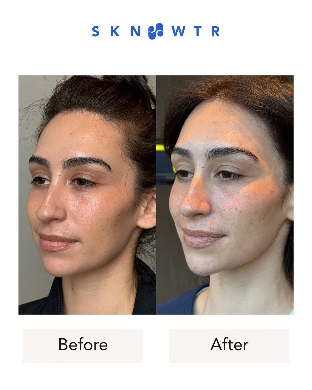 Subtle filler placement for the perfect, undetectable refresh. That's what we love at SKN WTR.