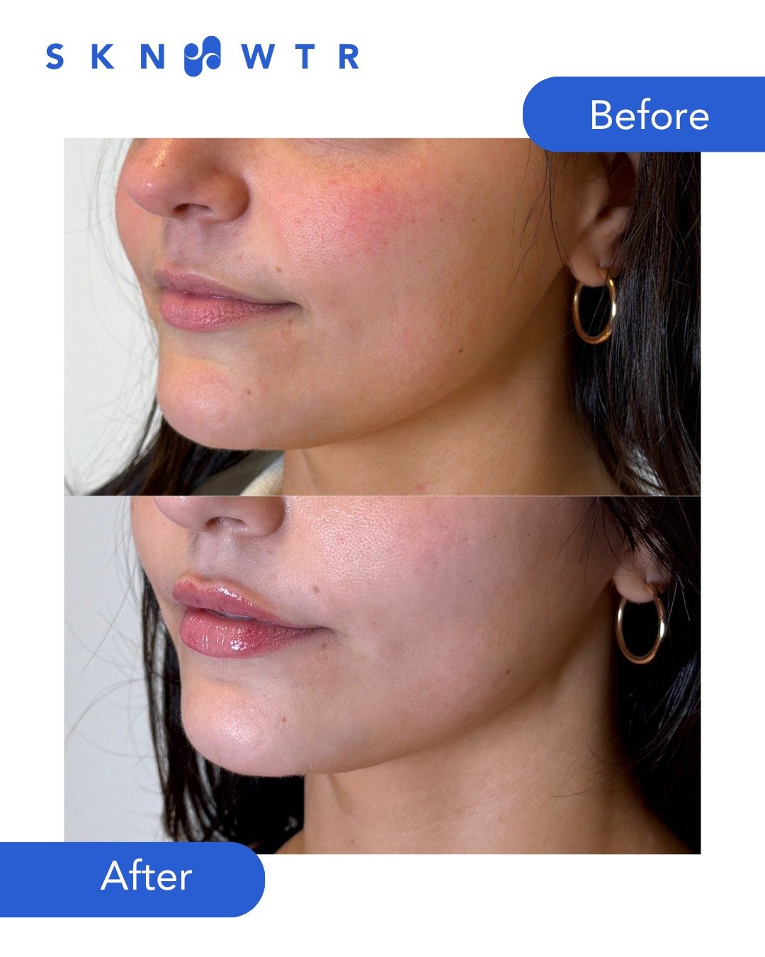 Friday lip refresh! Subtle results with perfect structure.