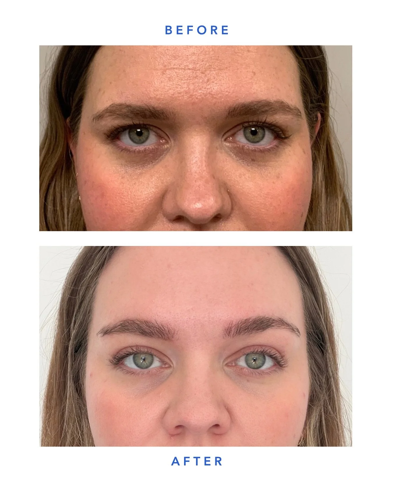 One of our favorite ways to use Botox.

With strategic placement, neurotoxin can help lift the brows, open the eye area, and create a more refreshed appearance &mdash; while maintaining natural movement.

Subtle adjustments. Noticeable difference.
&m