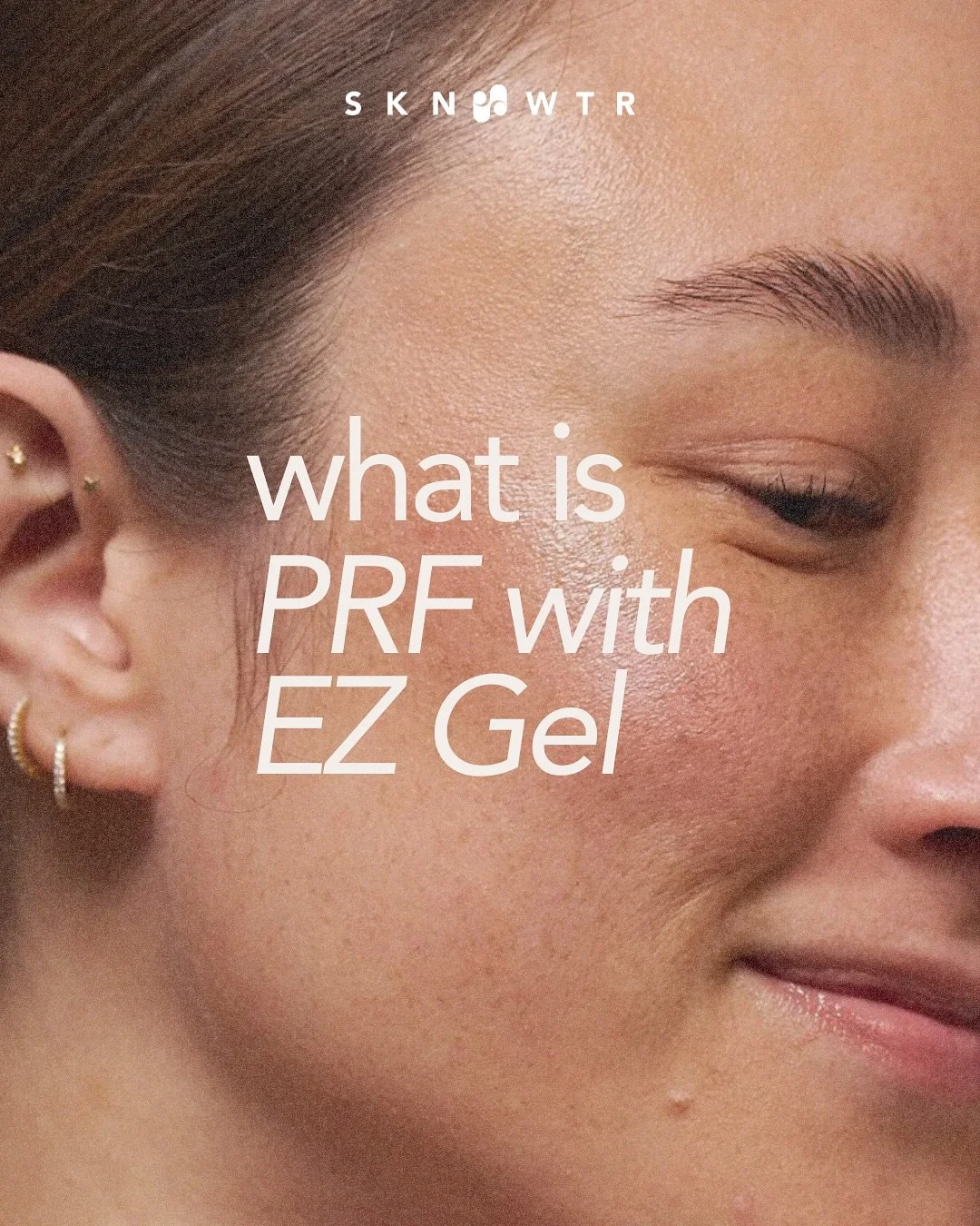 PRF with EZ Gel is one of our most natural approaches to restoring skin quality and volume.

Using your body&rsquo;s own growth factors, this treatment supports collagen production, improves texture, and gradually softens areas of volume loss.

A reg