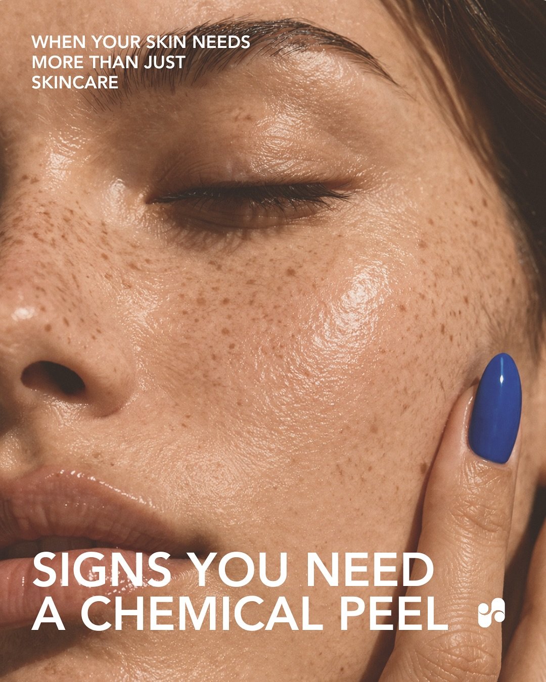 If your skin feels dull, uneven, or resistant to your current routine, it may be time for a chemical peel.

Peels work below the surface to improve tone, texture, and overall skin quality, creating brighter, more even skin over time.

A simple way to