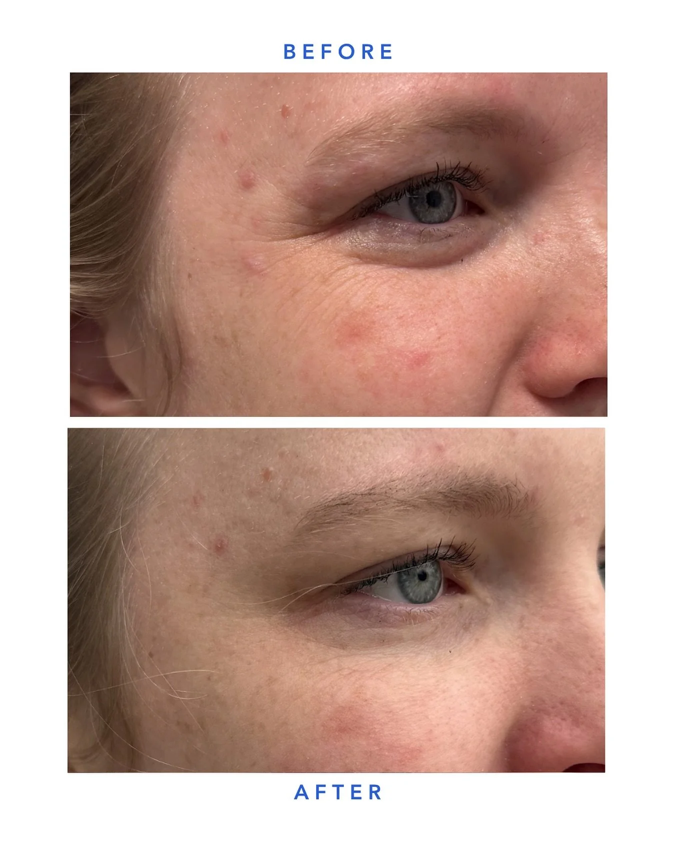 A subtle lift can make a noticeable difference.

With strategic neurotoxin placement, we can help open the eye area and improve the appearance of heavy eyelids while keeping results natural and balanced.

_____
SKN WTR📍Arsenal Yards Blvd-D133 Watert