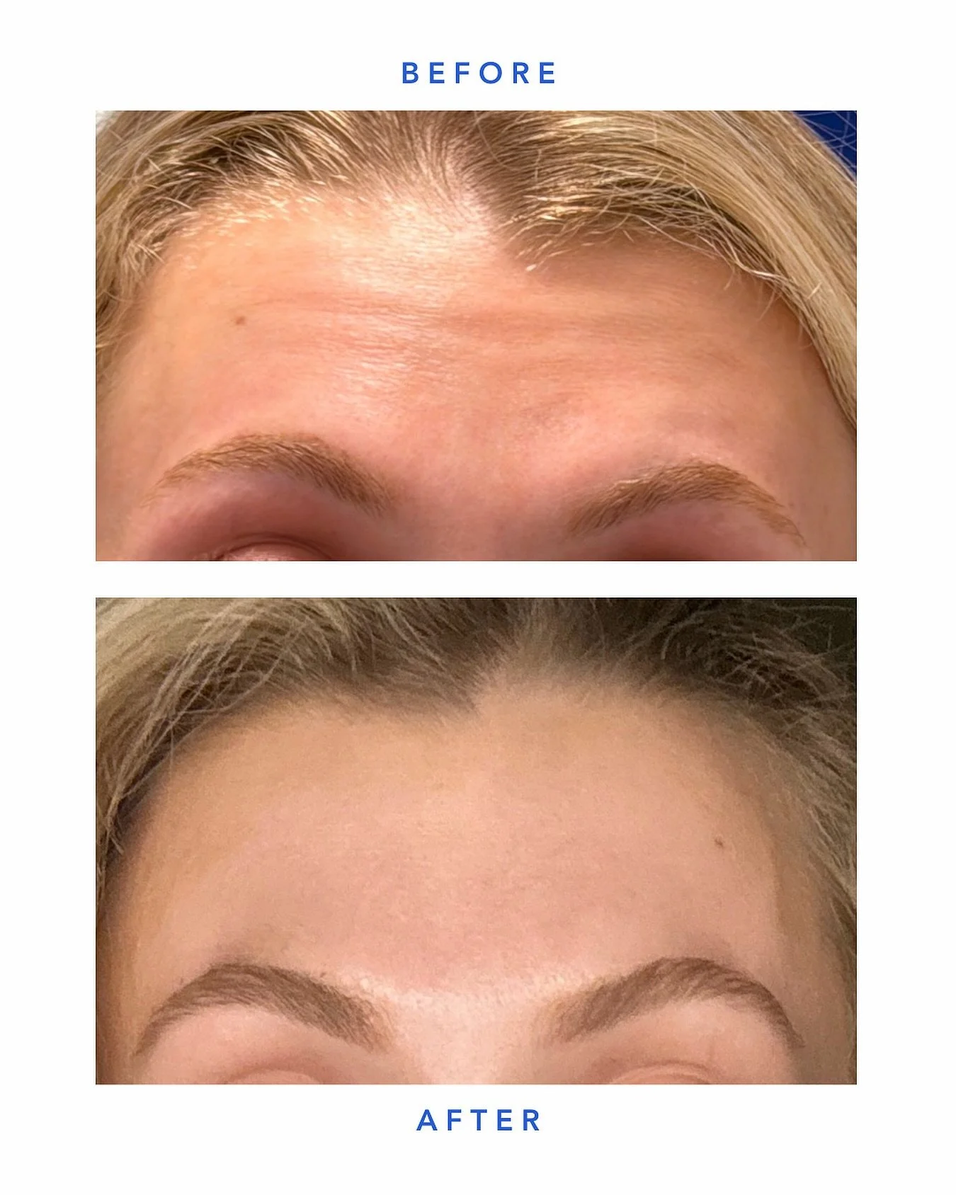 Forehead lines, softened...not frozen.

With precise neurotoxin placement, we&rsquo;re able to reduce the appearance of lines while maintaining natural movement and expression.

Subtle. Balanced. Intentional.

SKN WTR
📍Arsenal Yards Blvd-D133 Watert