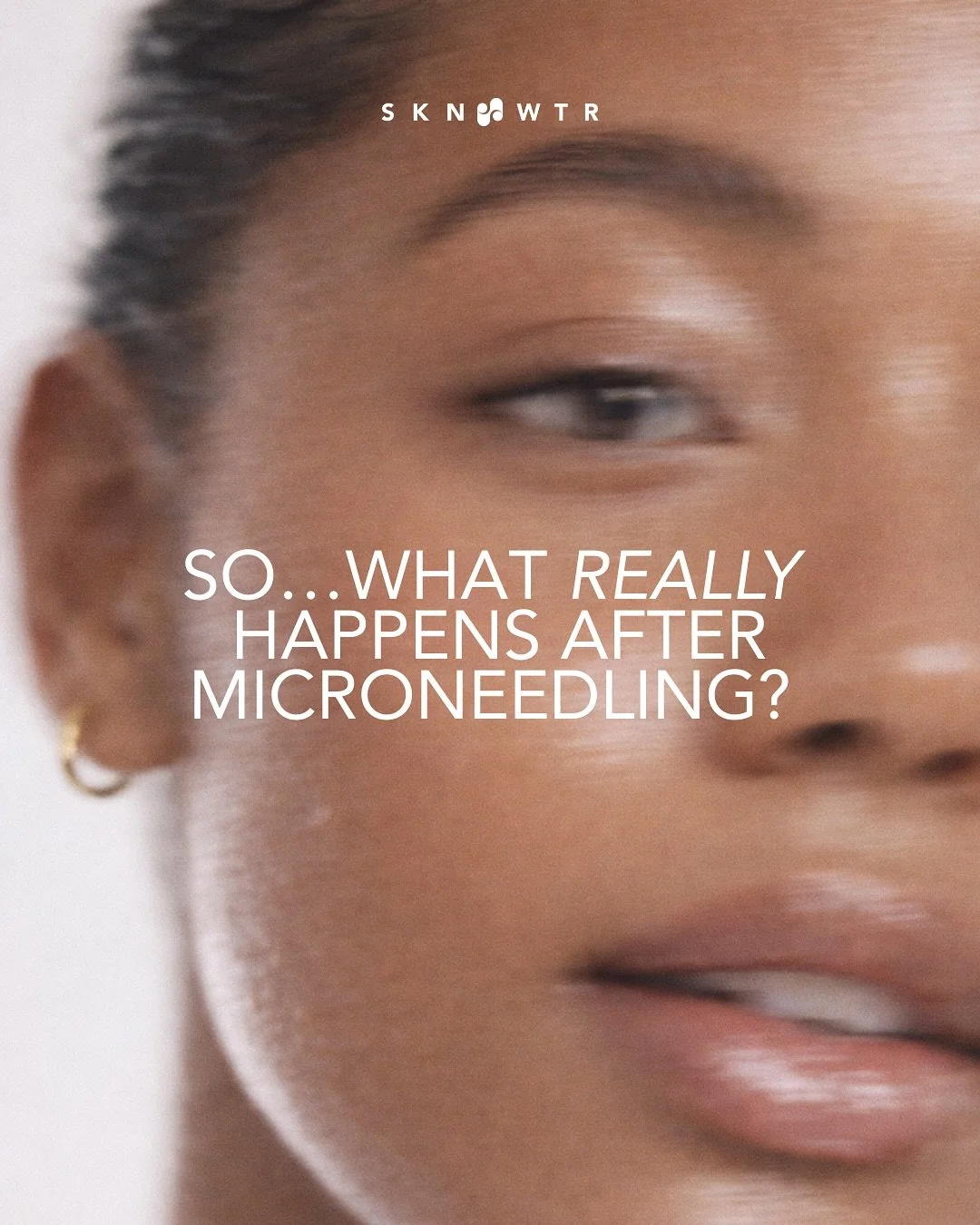Microneedling is a little downtime and a lot of payoff. Trust us. Thinking about it? We&rsquo;ll walk you through it.

SKN WTR
📍Arsenal Yards Blvd-D133 Watertown, MA 02472
📱(617) 214-3688
💻 www.sknwtr.com

-
-
-
-
#skinenhancement #skinspaboston #