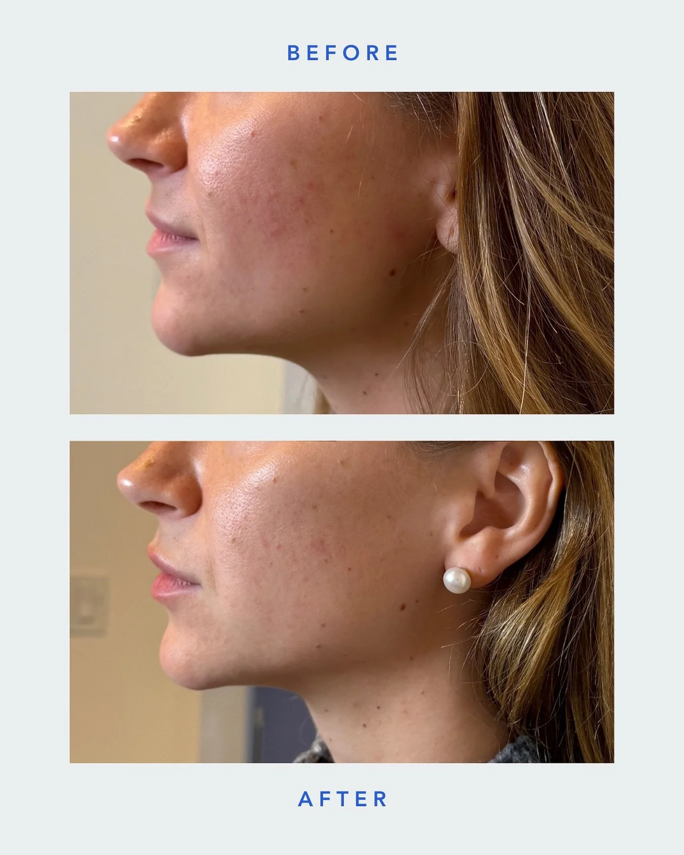 Facial balancing is all about harmony, proportion, and subtle enhancement.

Still you,&nbsp;just more refreshed, balanced, and refined.

SKN WTR
📍Arsenal Yards Blvd-D133 Watertown, MA 02472
📱(617) 214-3688
💻 www.sknwtr.com
-
-
-
-
#skinenhancement