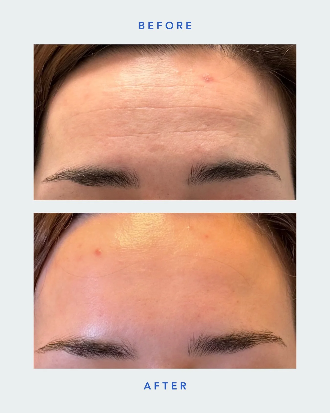 A refreshed look without looking overdone.

SKN WTR
📍Arsenal Yards Blvd-D133 Watertown, MA 02472
📱(617) 214-3688
💻 www.sknwtr.com

-
-
-
-
#skinenhancement #skinspaboston #enhancement #bostonmedspa #bostonfacialspa