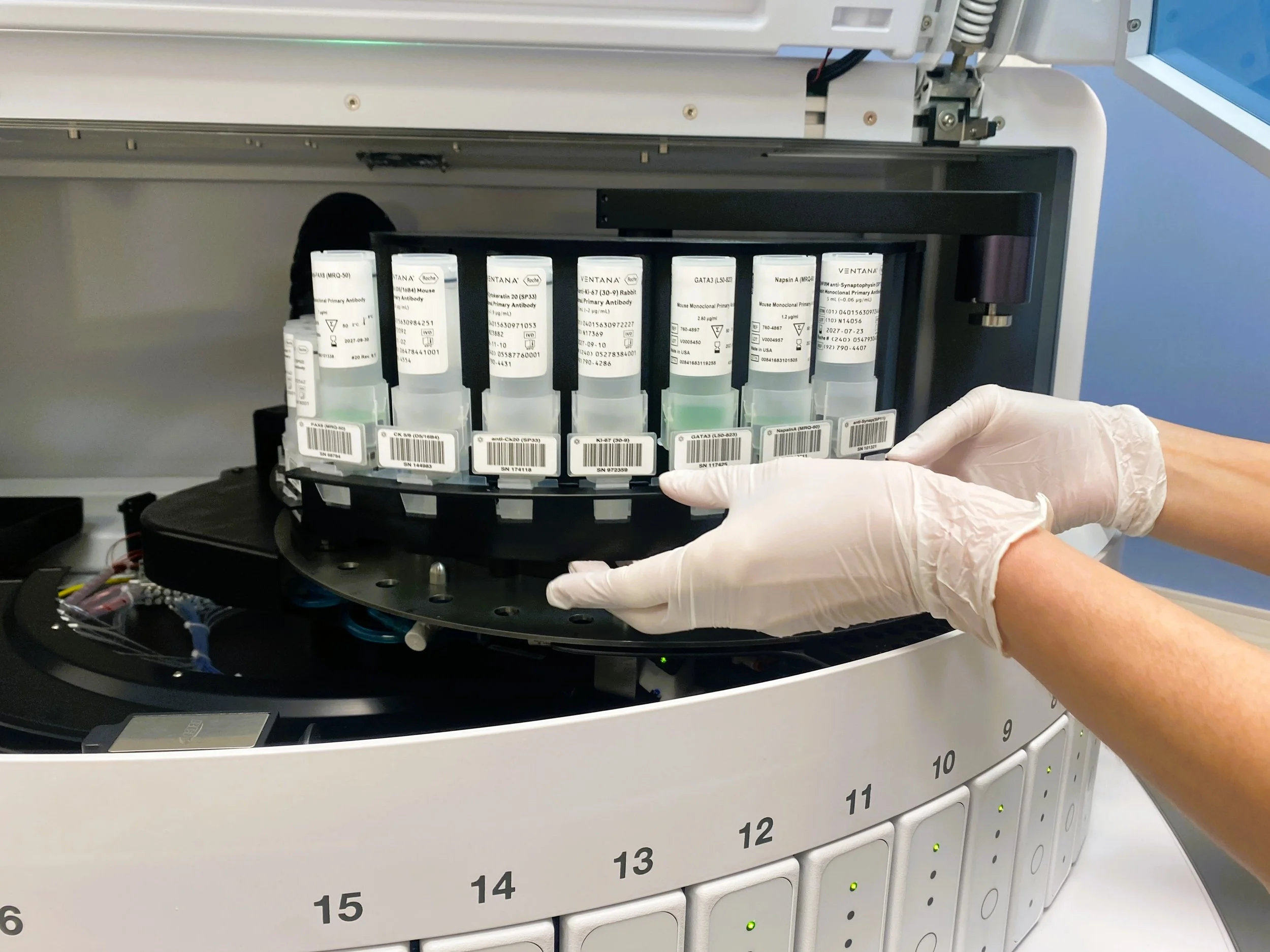 Имунохистохимия с предиктивни биомаркери вече се прилага в УМБАЛ “Св. Иван Рилски”