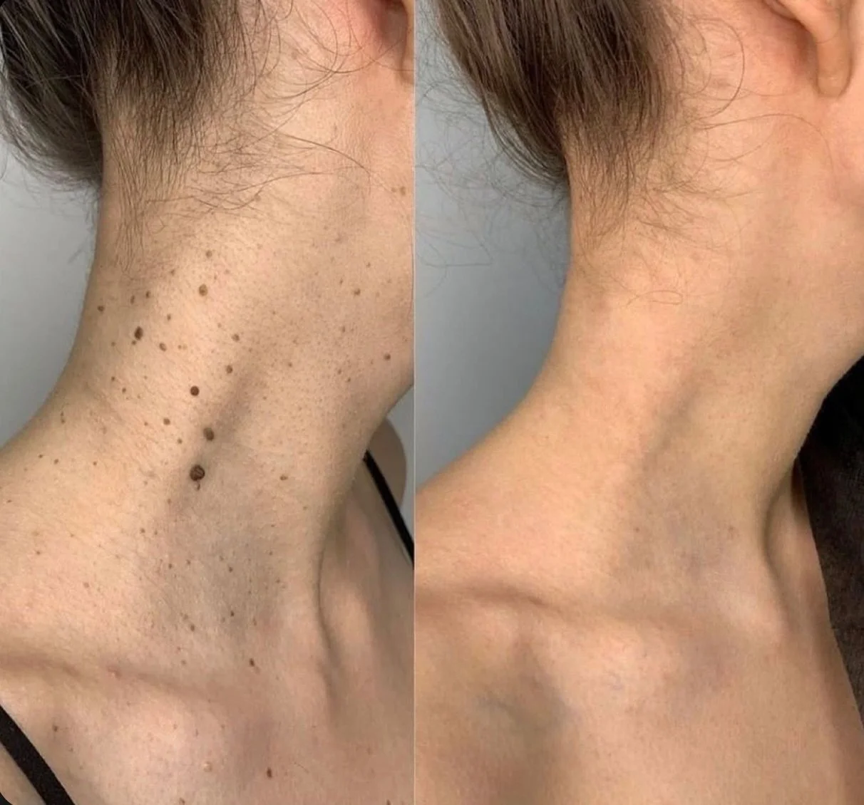 Van storende wratjes naar een gladde, egale huid ✨
Met onze gerichte laserbehandeling verwijderen we wratjes veilig en effectief, met zichtbaar resultaat.

Wil jij ook verlost zijn van wratjes?
Plan je consultatie en ontdek wat mogelijk is voor jouw 
