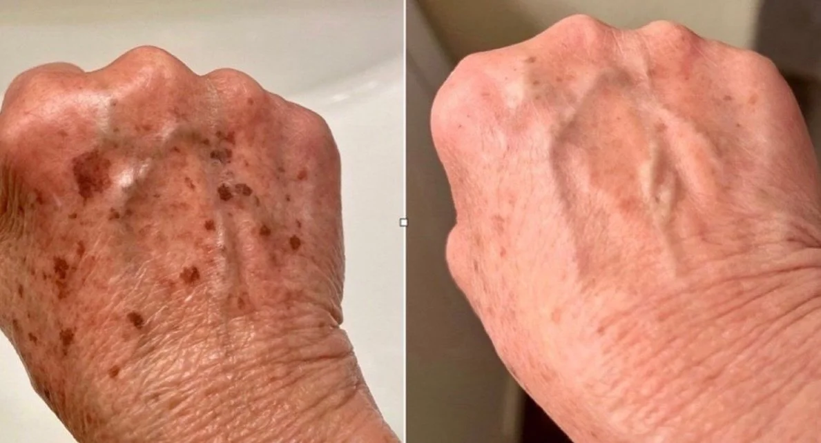Pigmentvlekken op de handen? Dat hoeft niet permanent te zijn ✨
Met onze laserbehandeling verminderen we zon- en ouderdomsvlekken zichtbaar en herstellen we een egalere huid.

Wil jij ook een frissere, jongere uitstraling van je handen?
Plan je consu