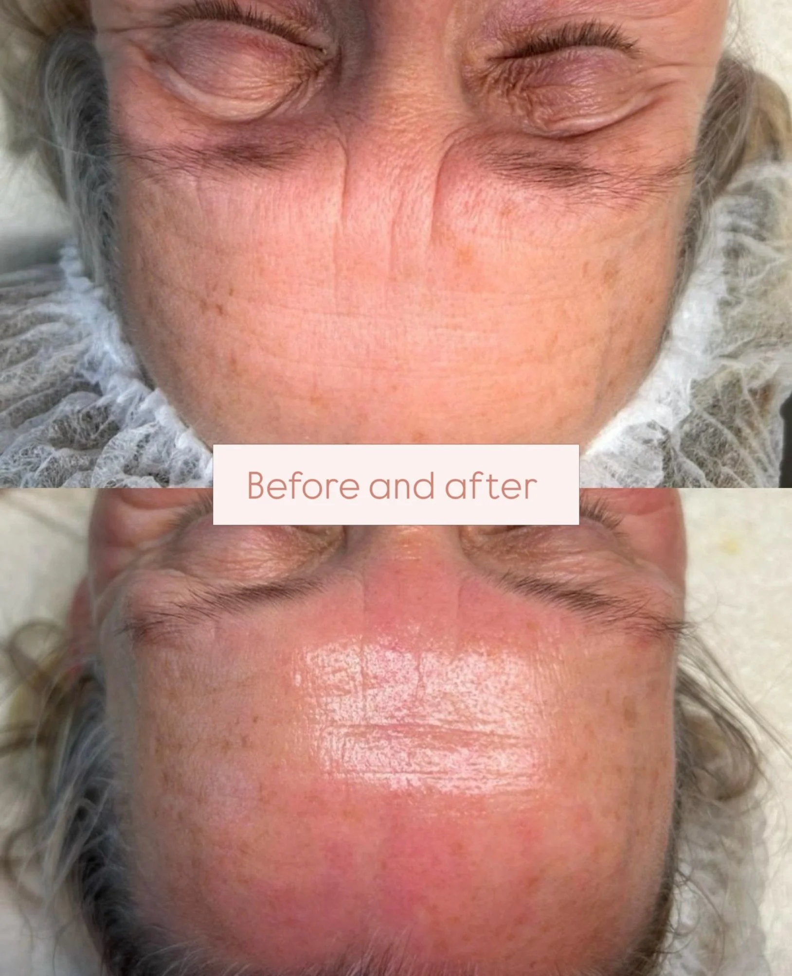 Een mooie before and after na een peeling pigmentatie/ anti aging.✨✨

#peeling #pigmentatie #ouderdomsvlekken #melasma #facials