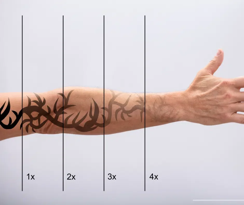 Laser-Tattoo-Removal-Process.png.webp