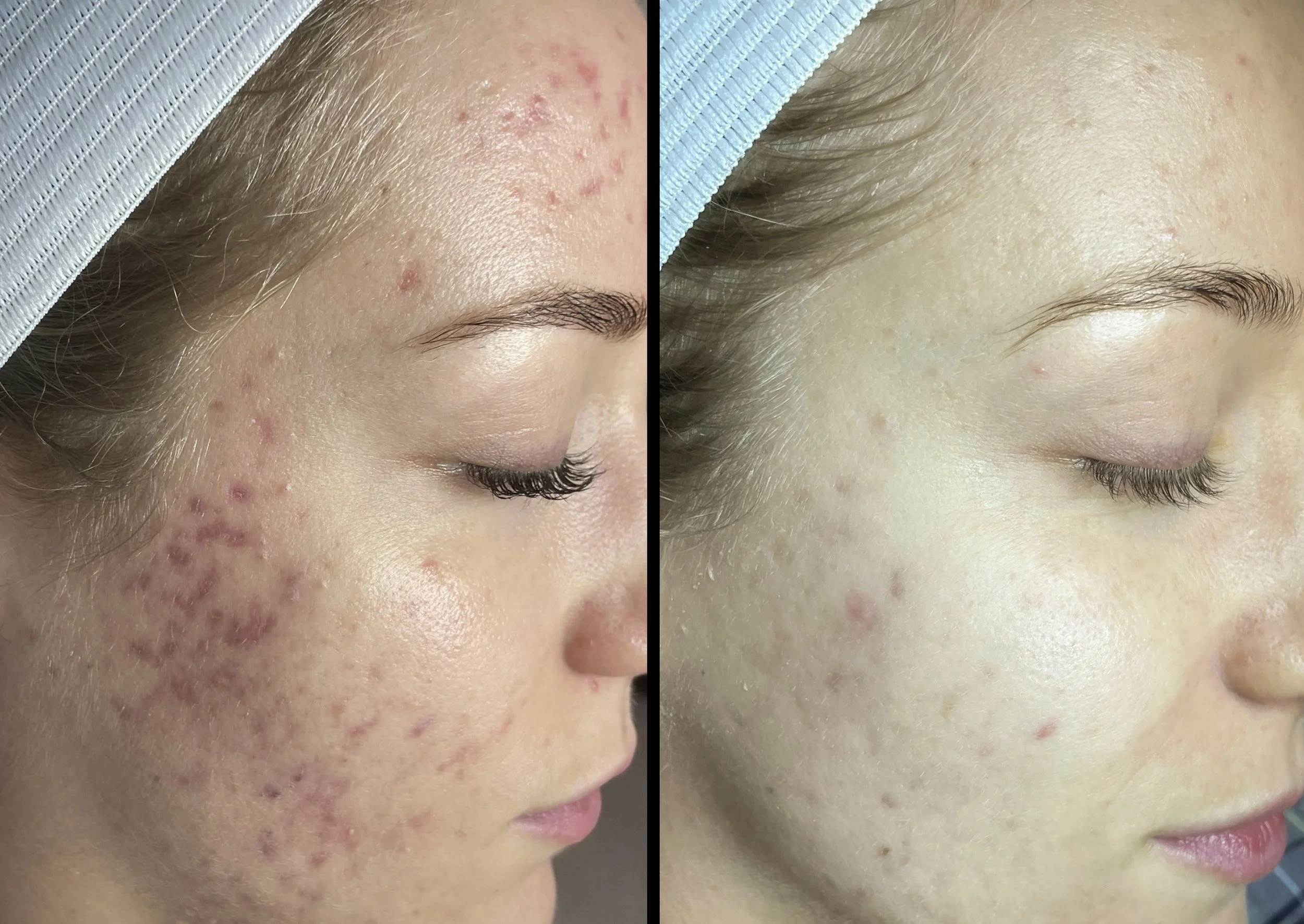 microneedling-near-me-brookfield.jpg