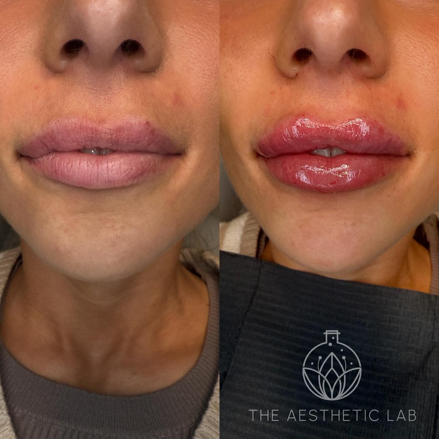 Subtle lift. Defined shape. Instant pout.

This beauty came in with previous filler and wanted a refreshed, more structured look&mdash;so we used the Mini Russian Lip technique to add height, enhance borders, and bring out her natural volume without 