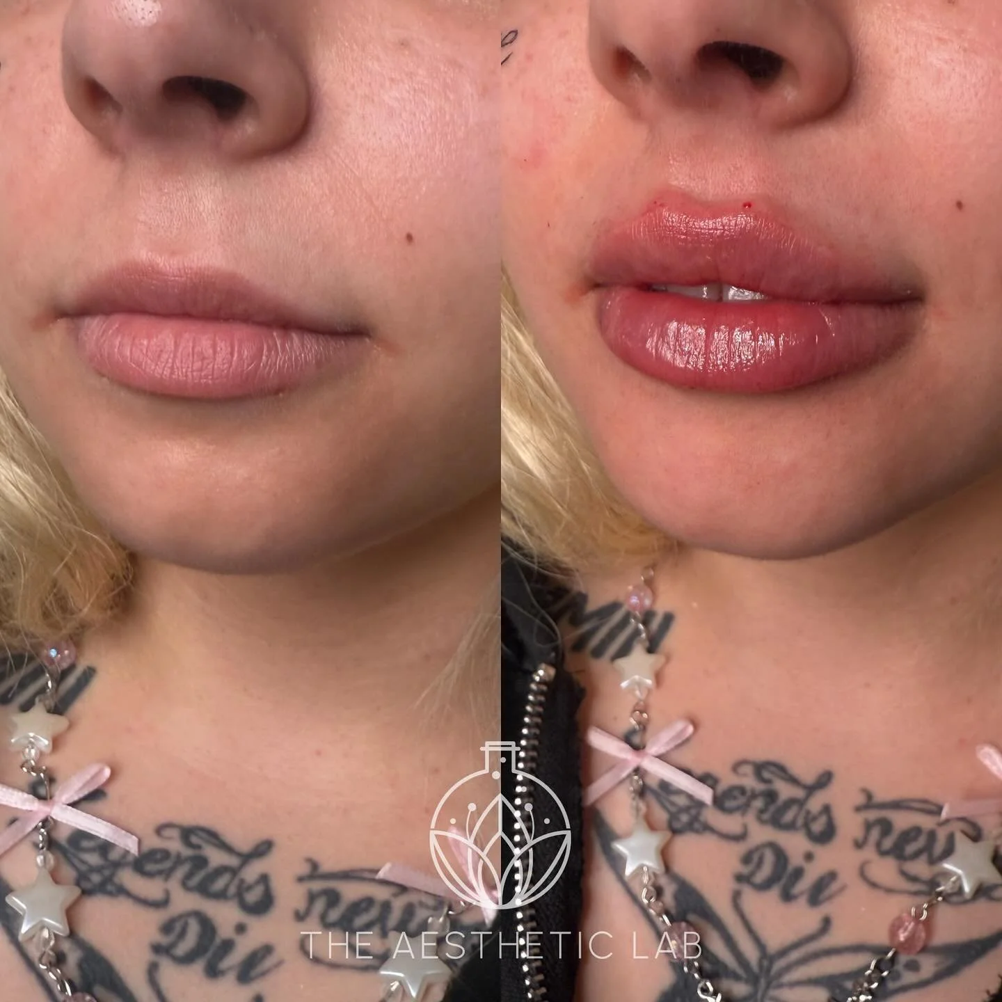 ✨ One Syringe, Big Impact! ✨
Subtle yet stunning transformation with just one syringe of lip filler. Adding volume, shape, and hydration for a fuller, juicy pout while keeping everything beautifully balanced and natural. 💋
Ready for your perfect l