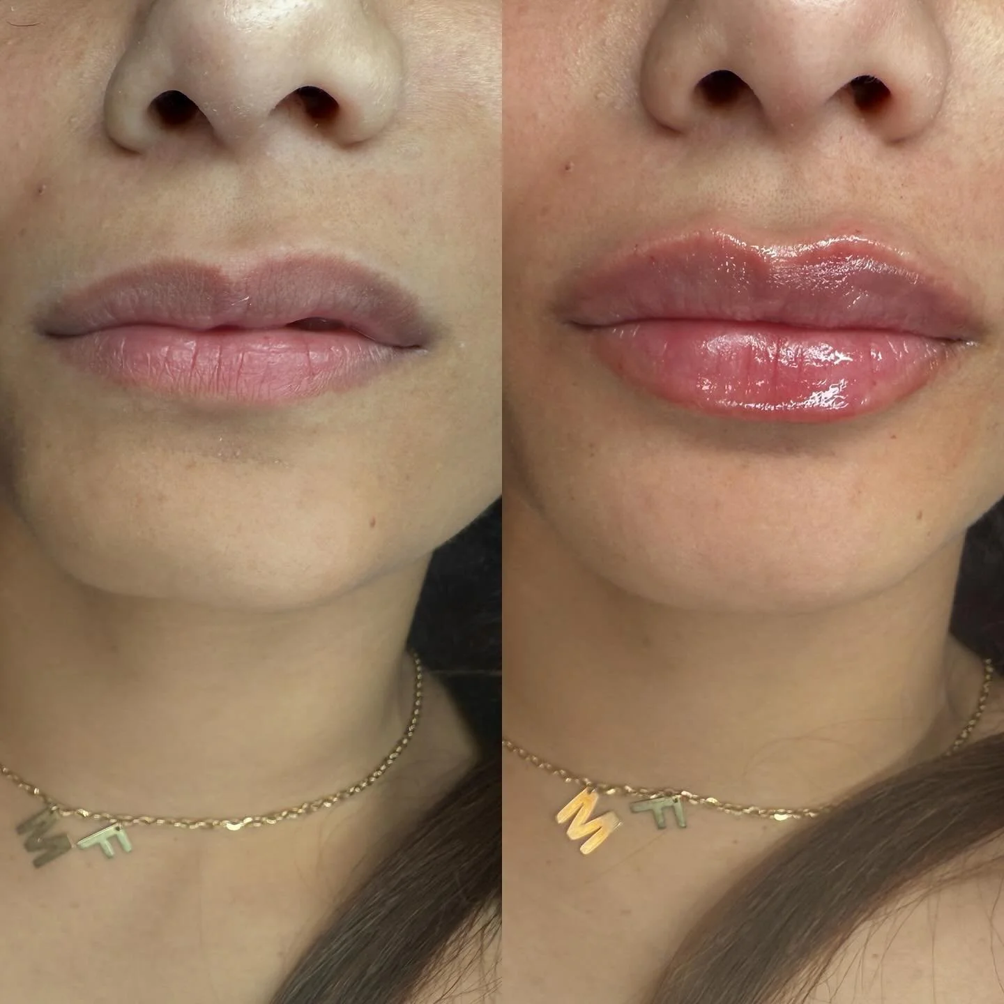 Nothing beats the confidence boost from a beautifully balanced pout! 💋
These stunning before & afters show how lip filler can enhance natural shape, restore volume, and add that perfect glossy finish. Subtle yet impactful. 🌸
💉 Treatment: Lip