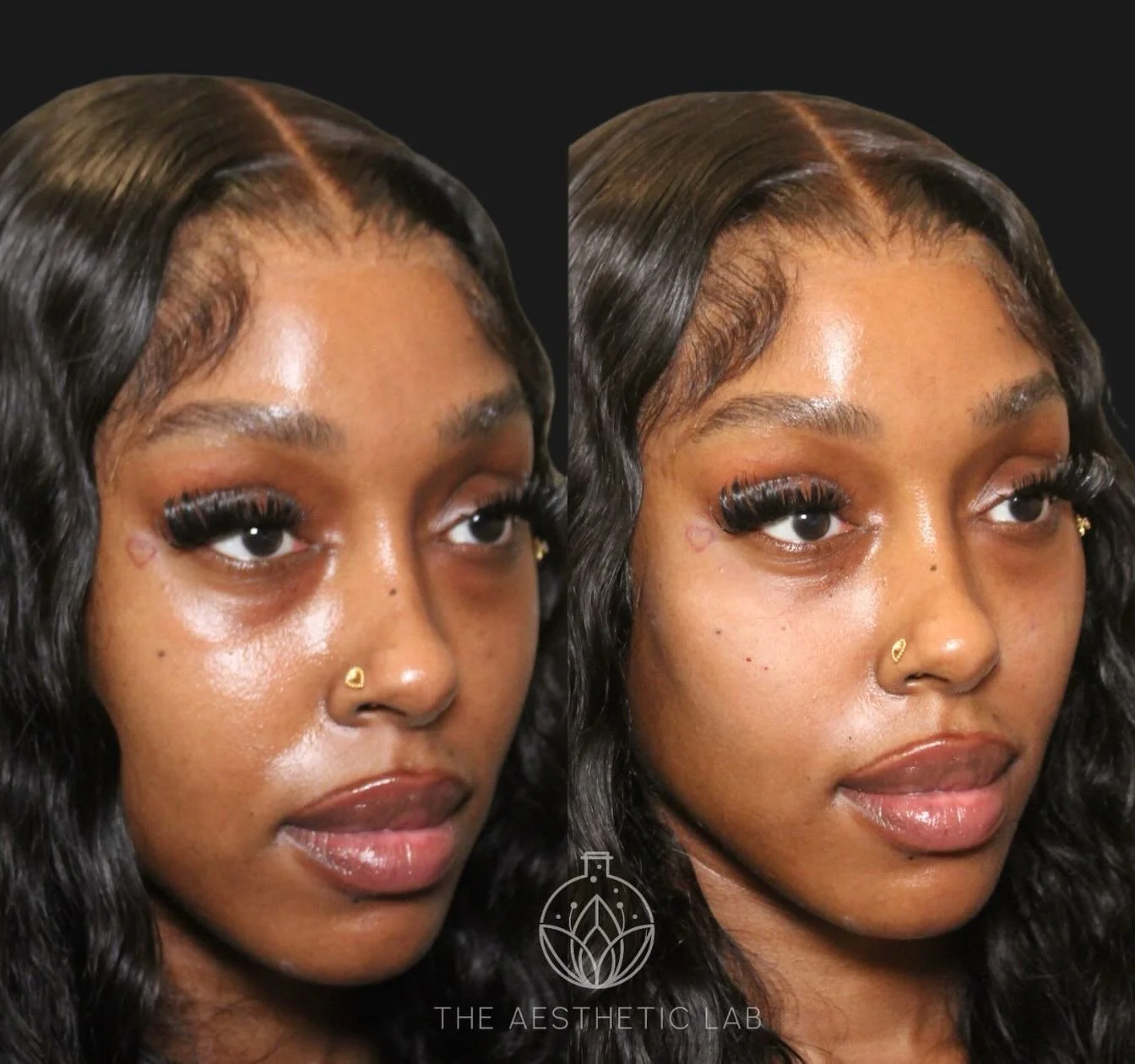 A little midface support goes a long way.
Using just one syringe, we restored volume, softened her under-eye hollowing, and kept everything beautifully natural.

DM to book.

#DermalFiller #CheekFiller #UnderEyeHollows #MidfaceRestoration #FacialBala