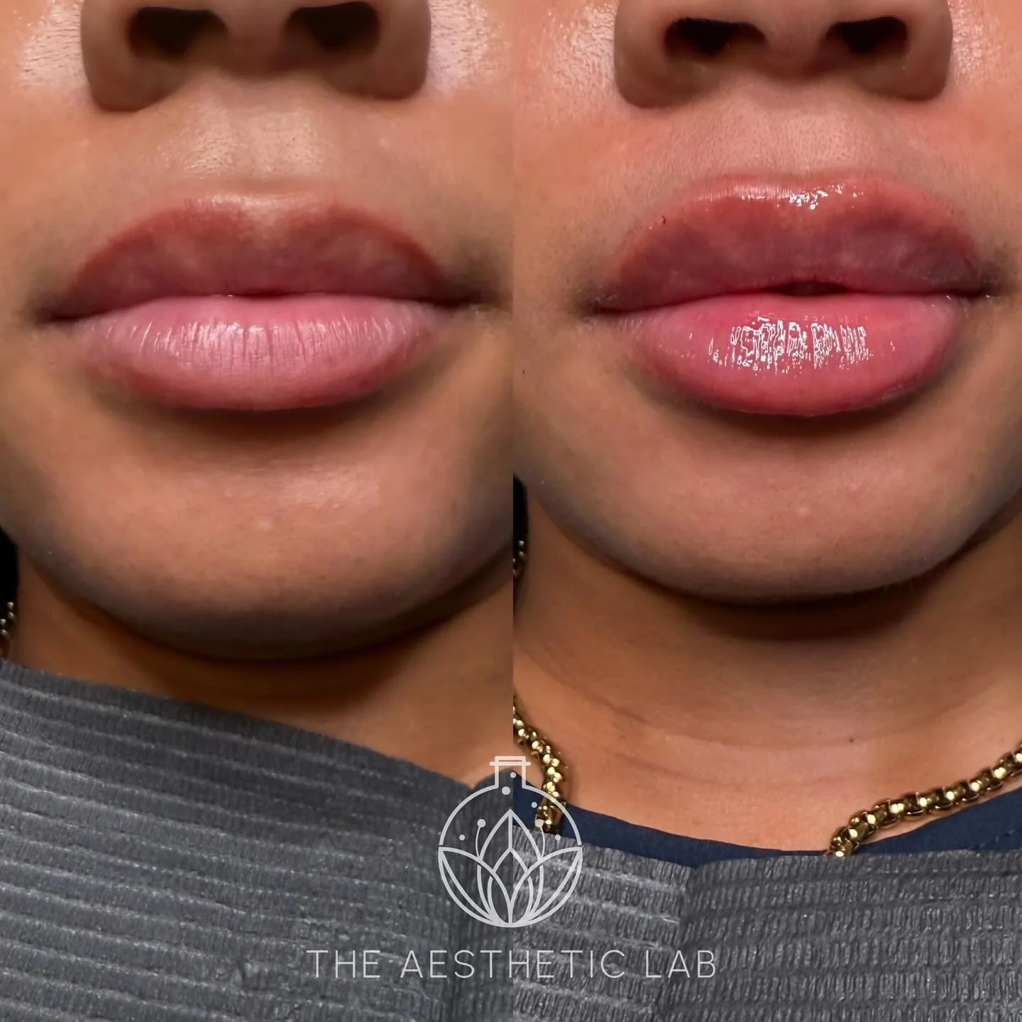 💋 One syringe = major upgrade!
Subtle but impactful lip filler enhancement for a fuller, more defined pout. ✨
We kept her natural shape and added just the right amount of volume for a balanced, juicy look!

📍Performed at The Aesthetic Lab | Ann Arb