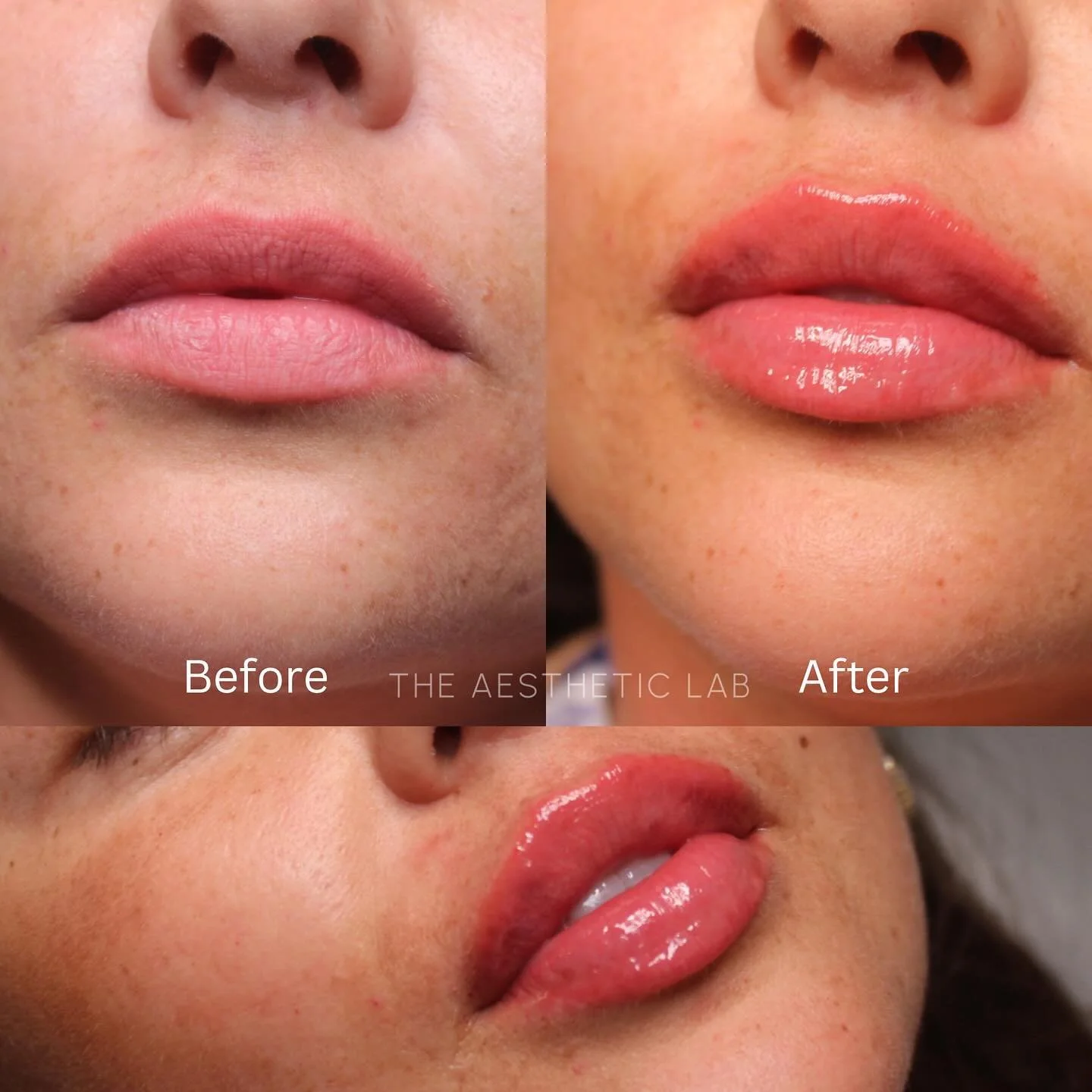 These lips were treated to restore natural volume, refine shape, and add a soft, hydrated glow &mdash; while keeping balance and harmony with her features.

✨ Results shown immediately post-treatment.
💉 Product: Ravenesse Lips +
📍 The Aesthetic Lab