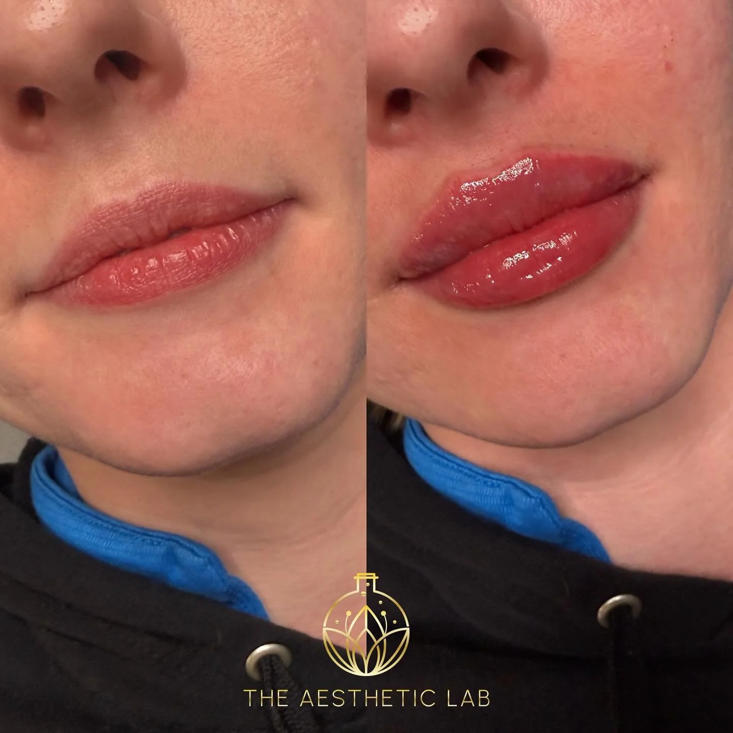 💋 Plump, hydrated, and oh-so-kissable! ⁣
This stunning lip transformation was achieved with just one syringe for a soft, natural enhancement that maintains balance and harmony with her features. ✨

Whether you&rsquo;re looking for a subtle refresh o