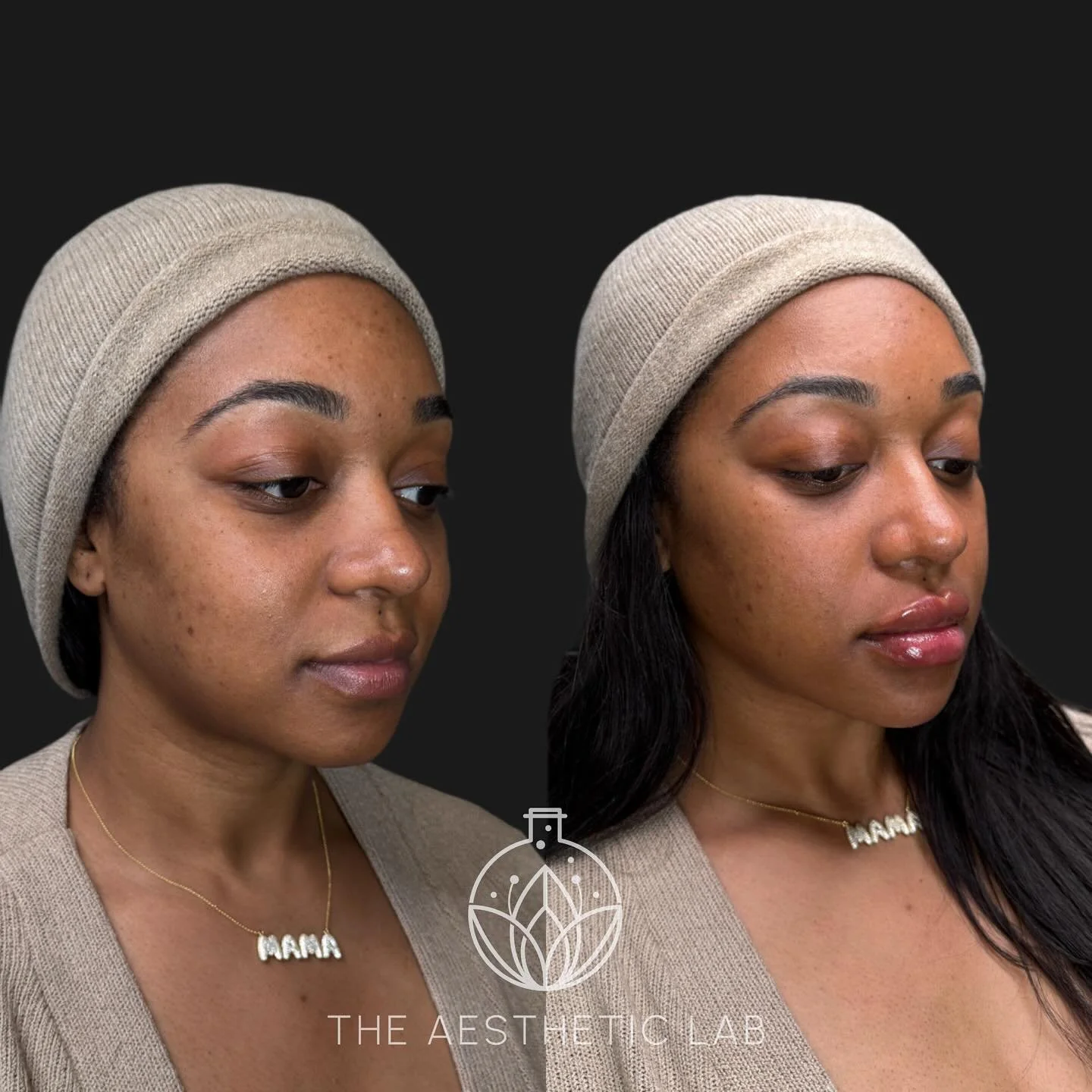✨ Lip &amp; Chin Glow-Up ✨

Balancing proportions, enhancing curves, and keeping it beautifully natural. 💋

This stunning transformation features:
💉 Lip filler for volume and definition
💉 Chin filler to refine and harmonize her profile

Because su