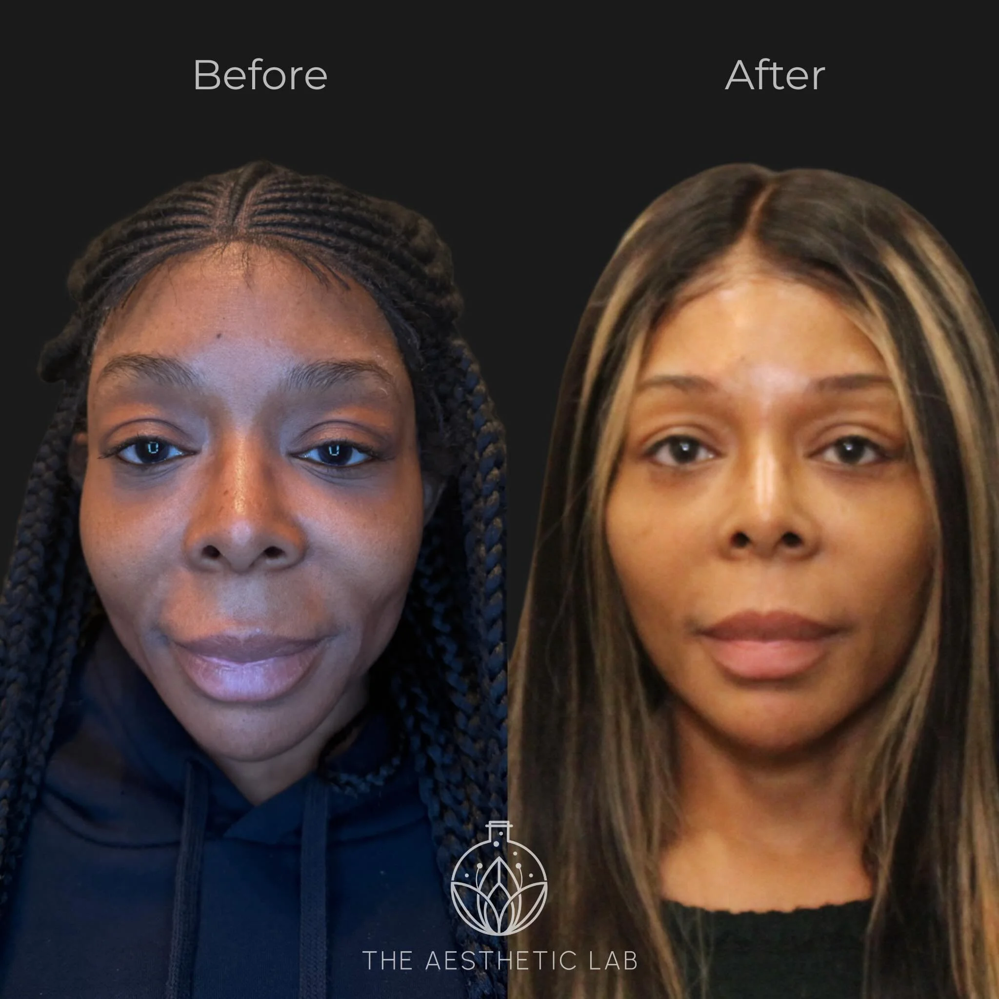 This one is for the girls who understand that subtle changes over time create the most beautiful transformations ✨

Over the past year, we took a customized multiple modality approach using filler, Sculptra, and Botox to restore balance, soften shado