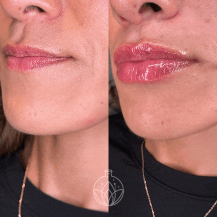 Lipfiller1.gif