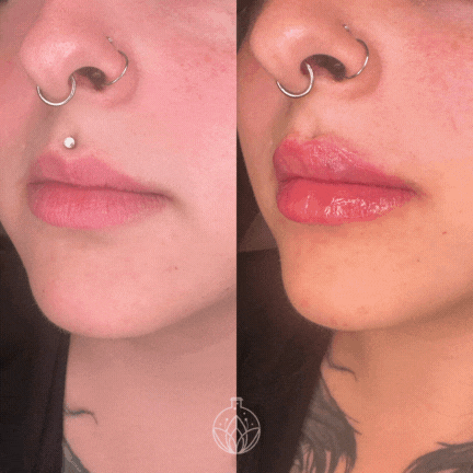 LipfillerBA.gif
