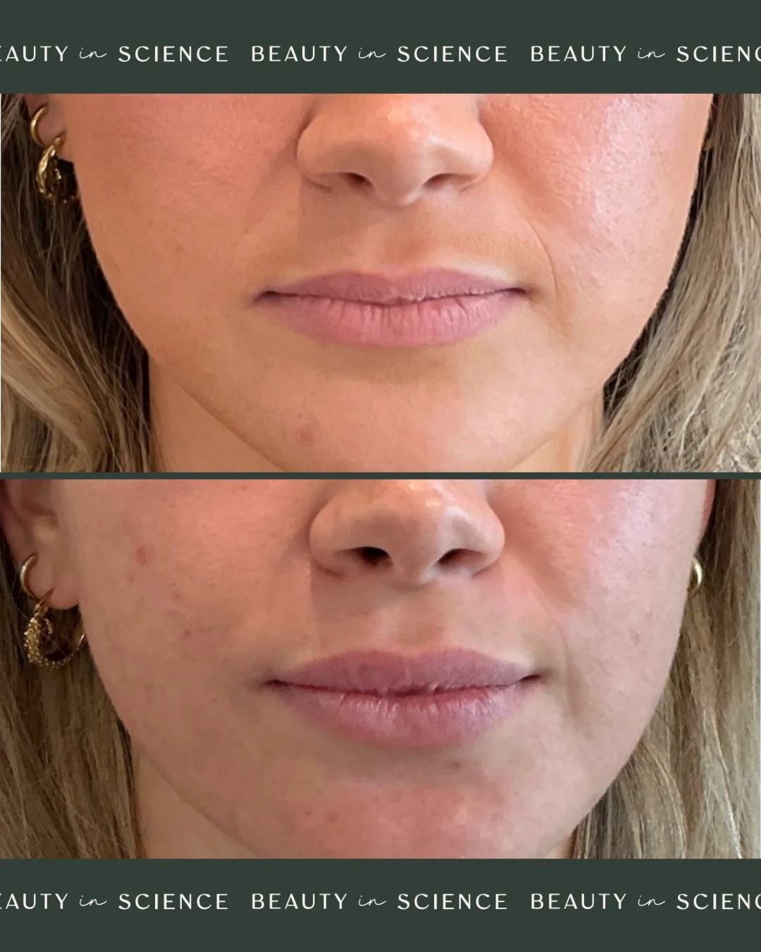 Subtle. Balanced. Just enough. 👄 This first-time lip filler client wanted a touch of volume and shape, without going overboard. Her results speak for themselves: softly enhanced lips that still feel 100% her.⁠
⁠
At Beauty in Science, our approach to
