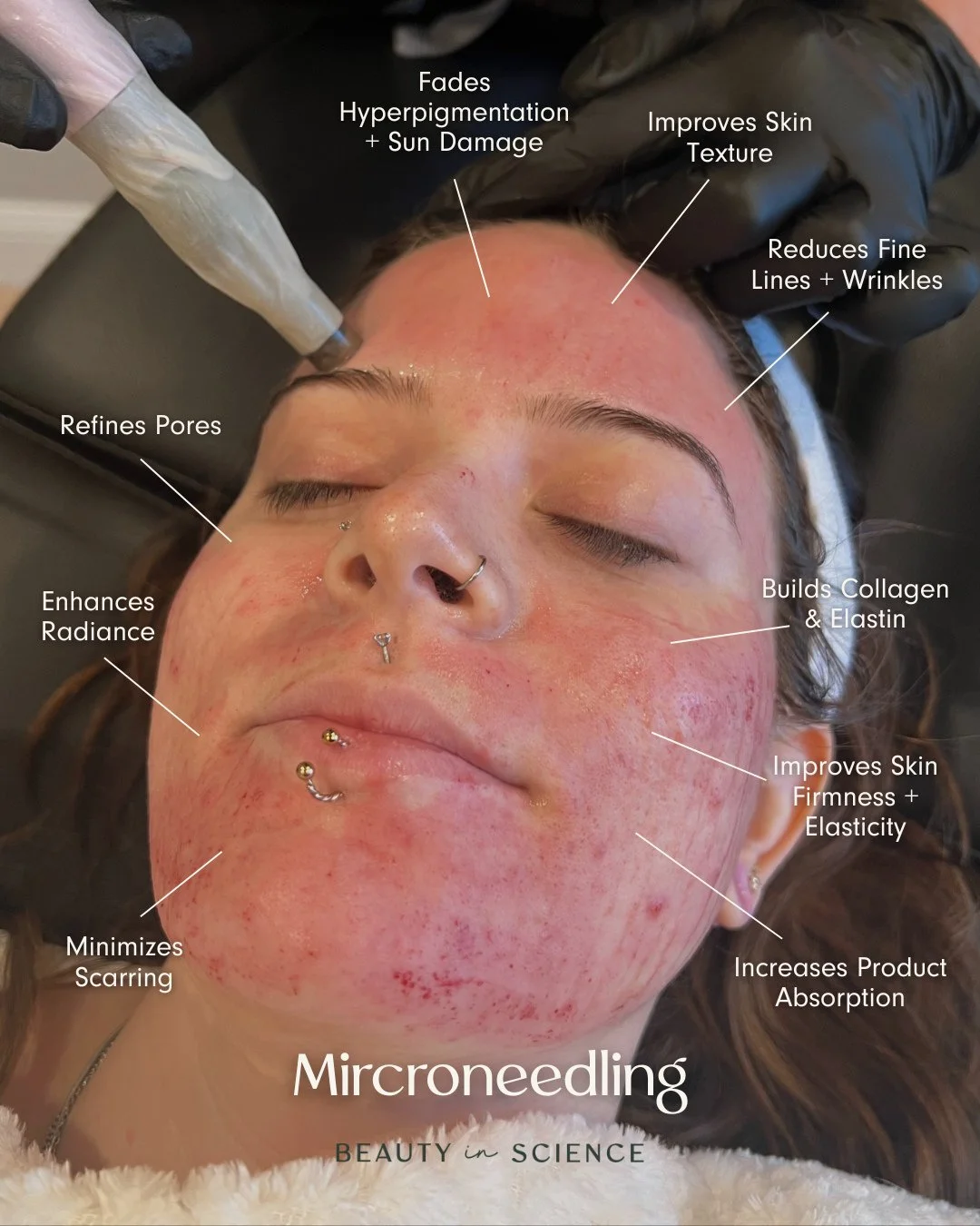 The glow-up your skin&rsquo;s been waiting for ✨⁠
⁠
This collagen-stimulating treatment does so much more than meets the eye &mdash; from softening fine lines to smoothing texture, fading sun damage, shrinking pores, and giving your skin that firm, r