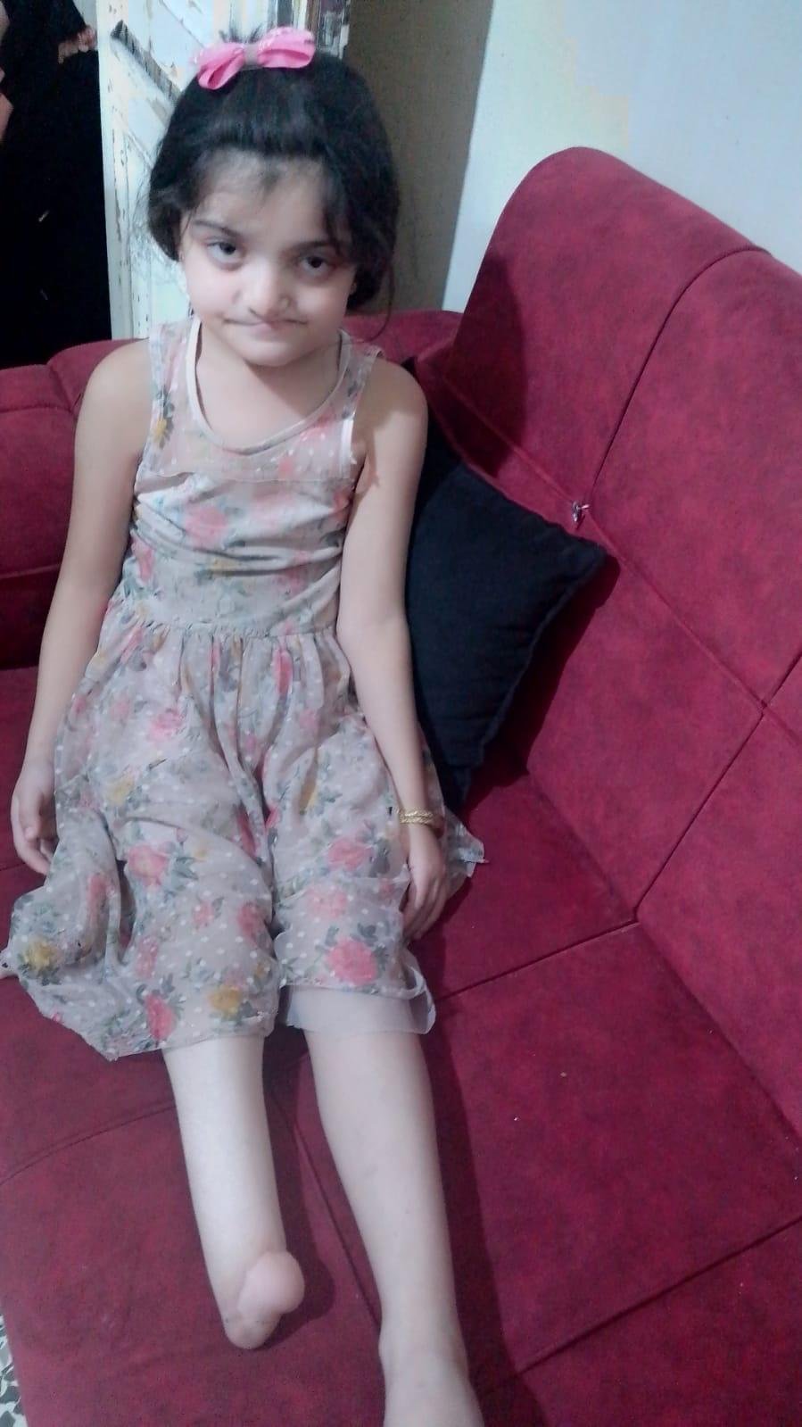 child amputee foot