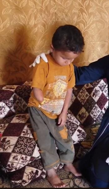 Child with arm amputation