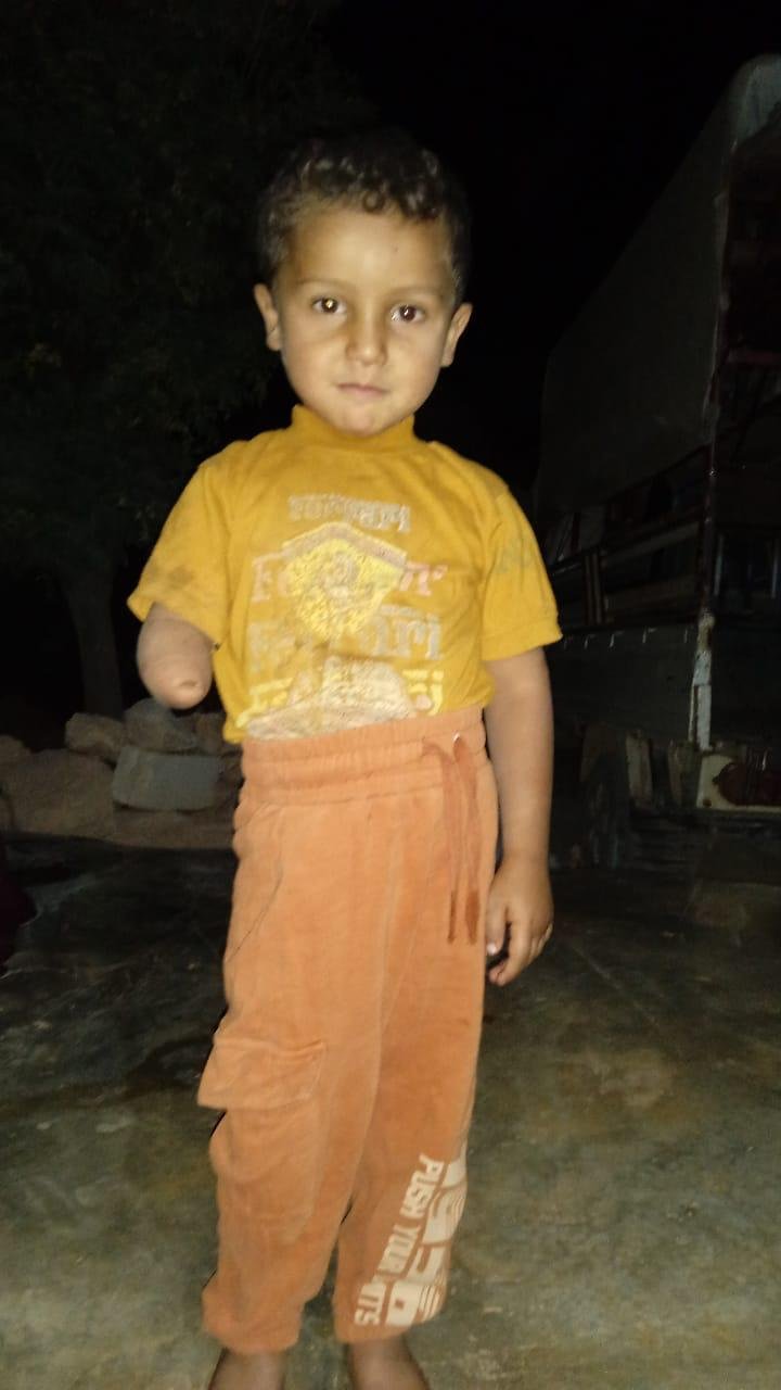 child arm amputation physiotherapy