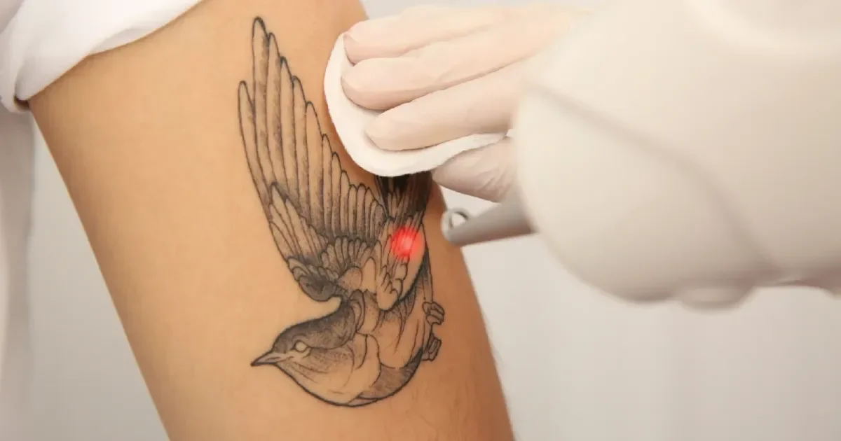 Laser Tattoo Removal