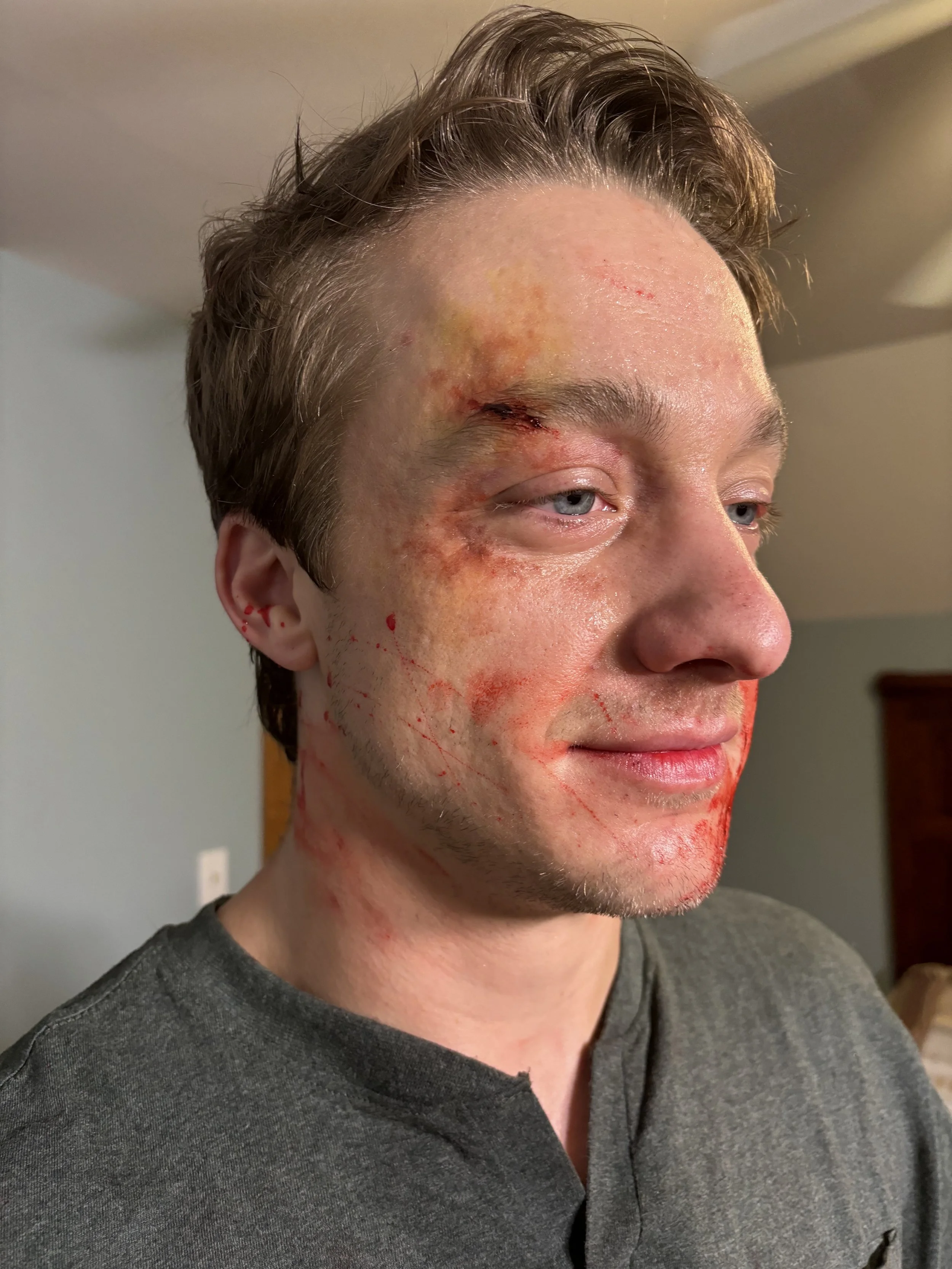 hammerwound2.jpg