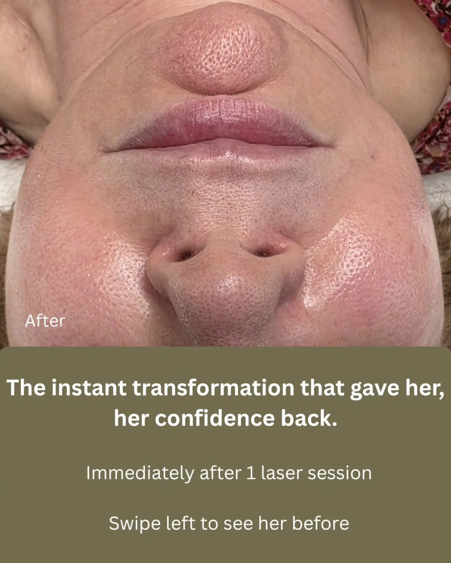Did you know our laser also treats unwanted vasular lesions such as dialed capillaries, spider veins, and cherry angioma at @banyanskin. You can transform your skin with just one laser session. 

I'm so proud of these results and we're not even finis