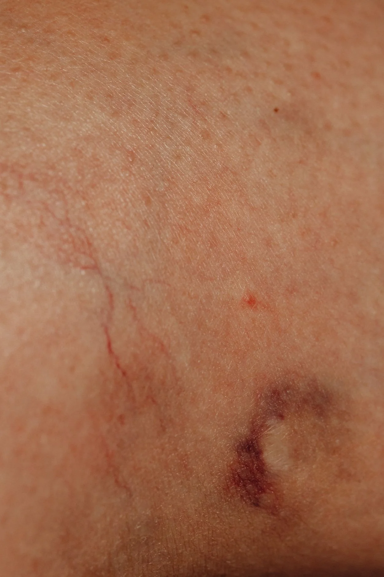 laser for broken capillary