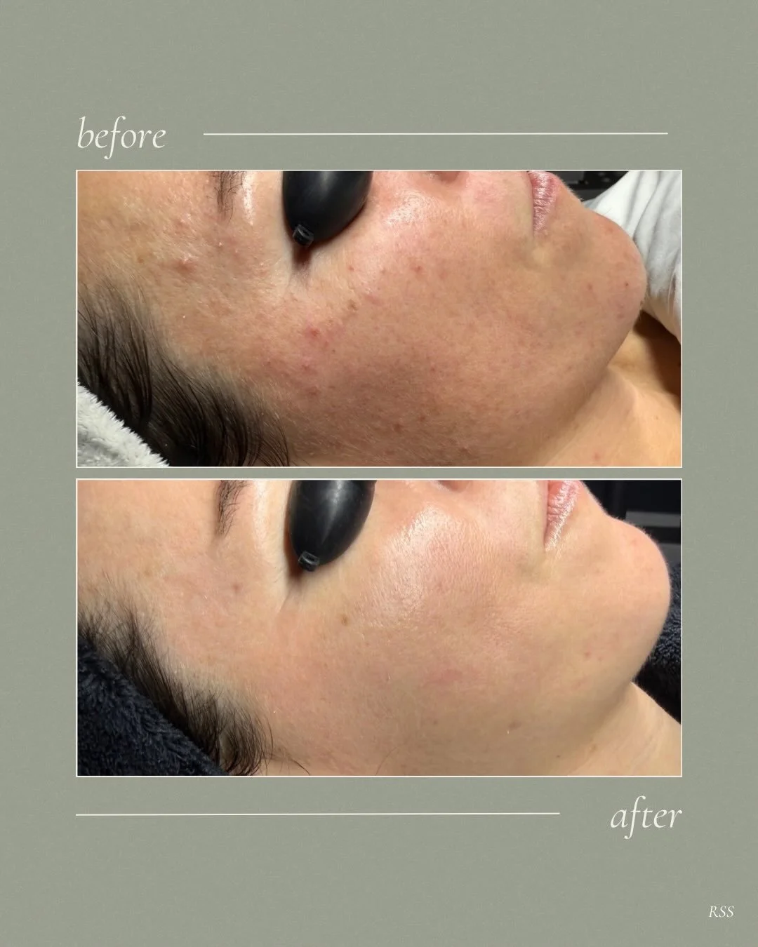 Not all skincare trends are meant for your skin 💔 
My client was dealing with congestion and texture throughout from using products that weren&rsquo;t suited for her skin type.

With a customized routine and the right ingredients, we were able to cl