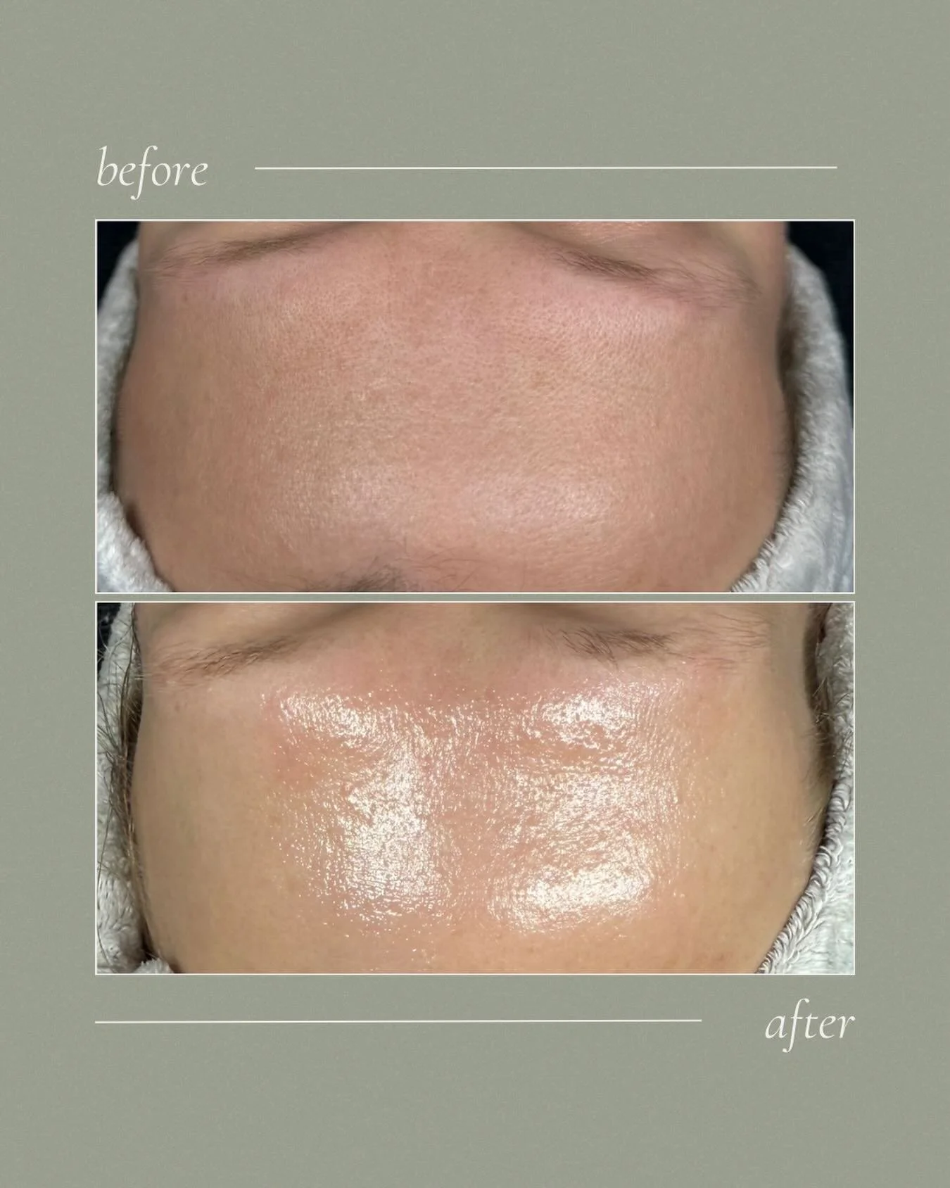 ✨ One treatment. Immediate results. ✨

Improved hydration, enhanced glow, and healthier looking skin after a professional facial treatment 💧🤍

While healthy skin is built through consistency, it&rsquo;s always exciting to see the immediate benefits
