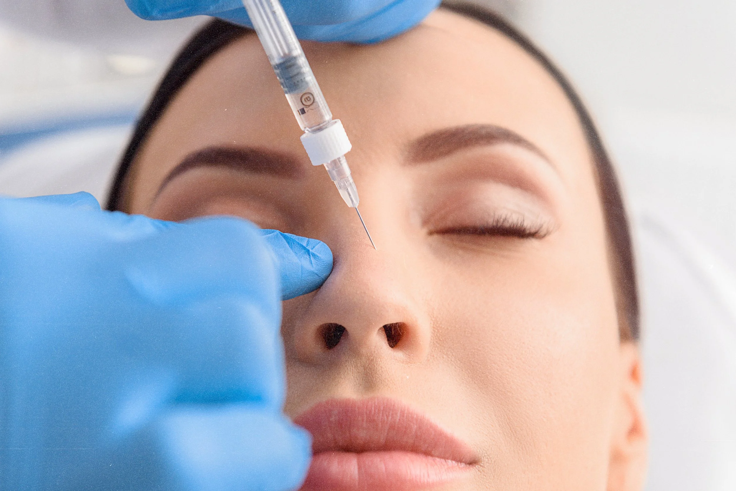Botox treatment for bunny lines on the nose bridge in top-rated Birmingham clinic.