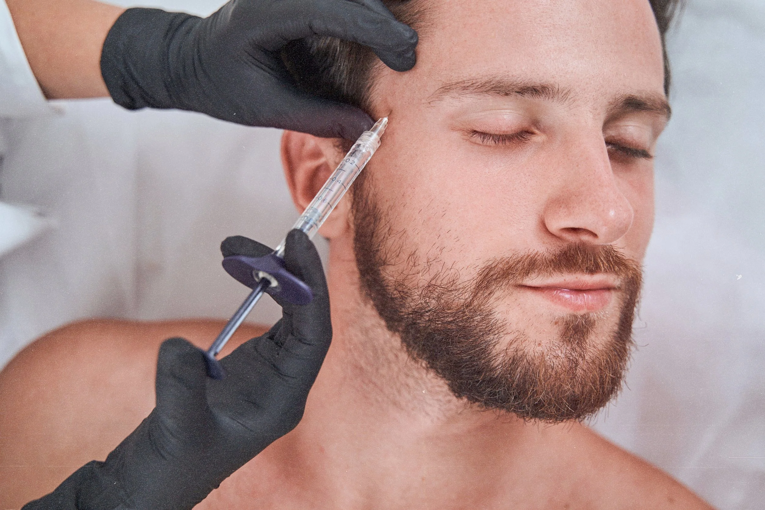 Volume restoration in temple area using fillers at Birmingham clinic.