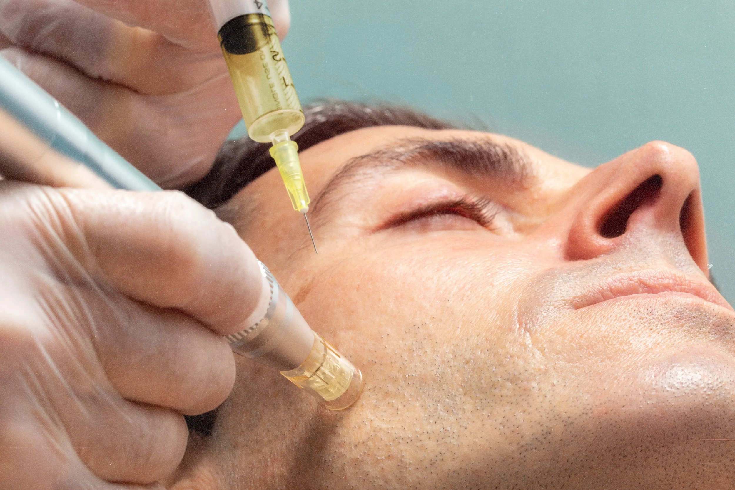 Mesotherapy with vitamins and peptides for glowing skin at Birmingham clinic.
