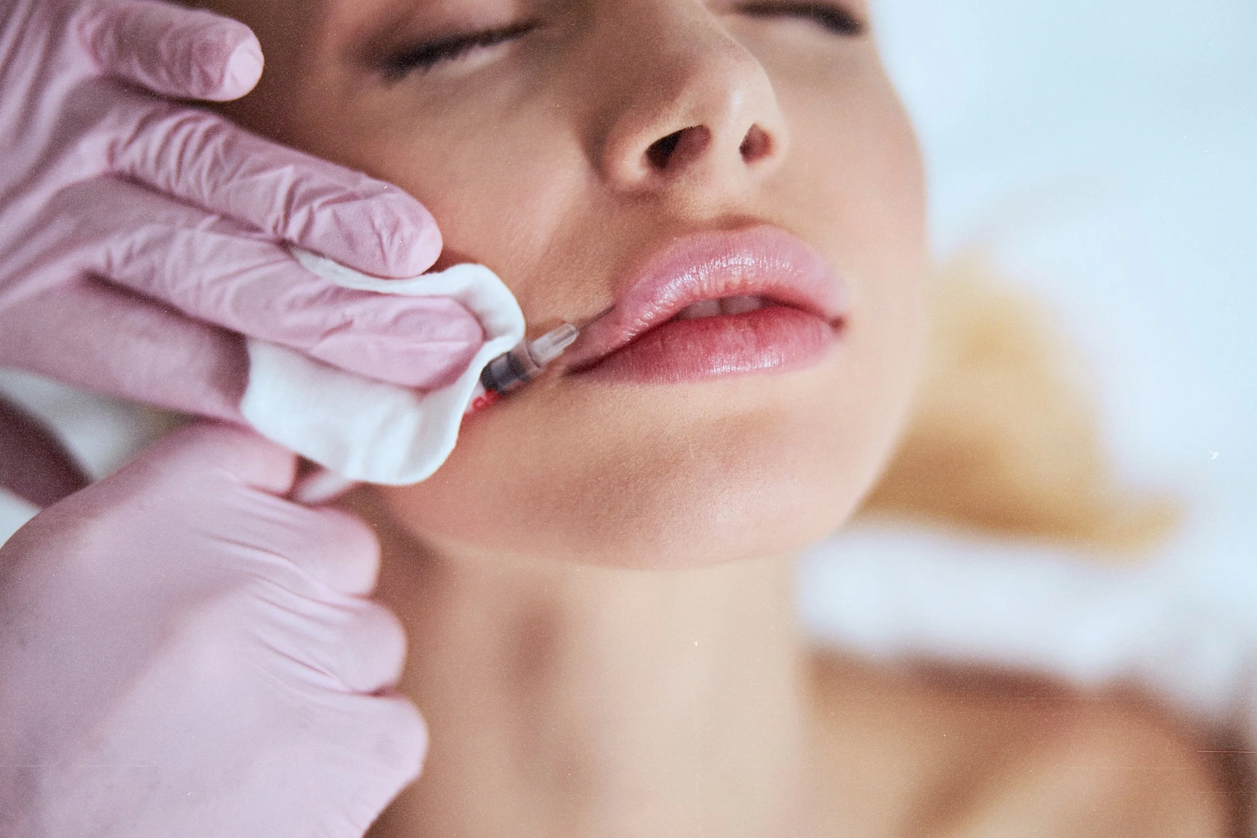 Expert dermal filler nodule correction using advanced techniques in Birmingham.